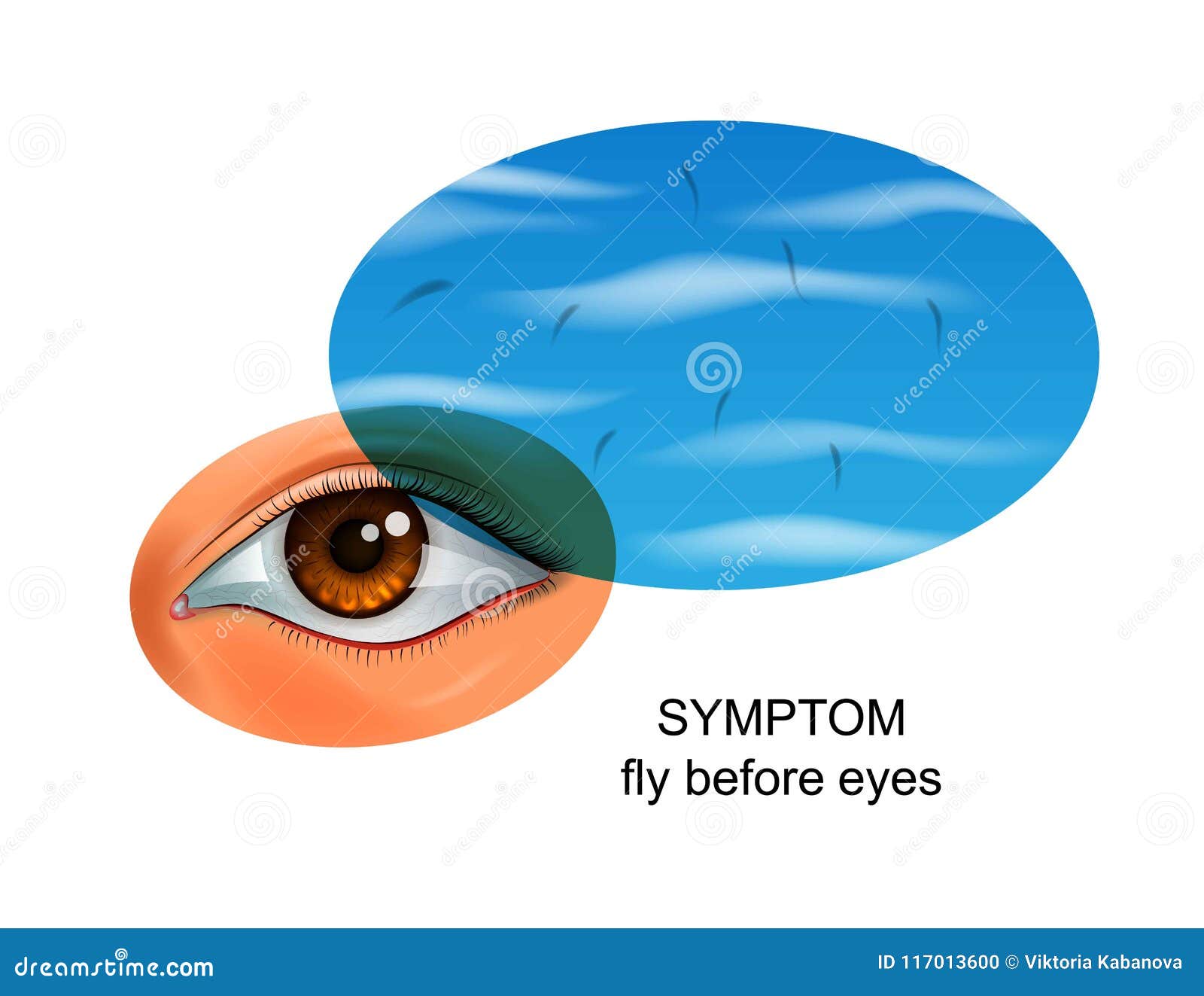 Flies before Eyes. Symptom of Eye Diseases Stock Vector Illustration of dislocation, allergic