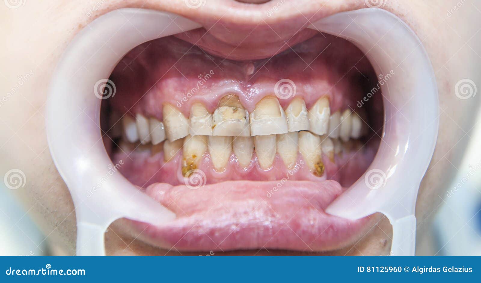 Fluorosis dental foto de archivo. Imagen de tratamiento 81125960