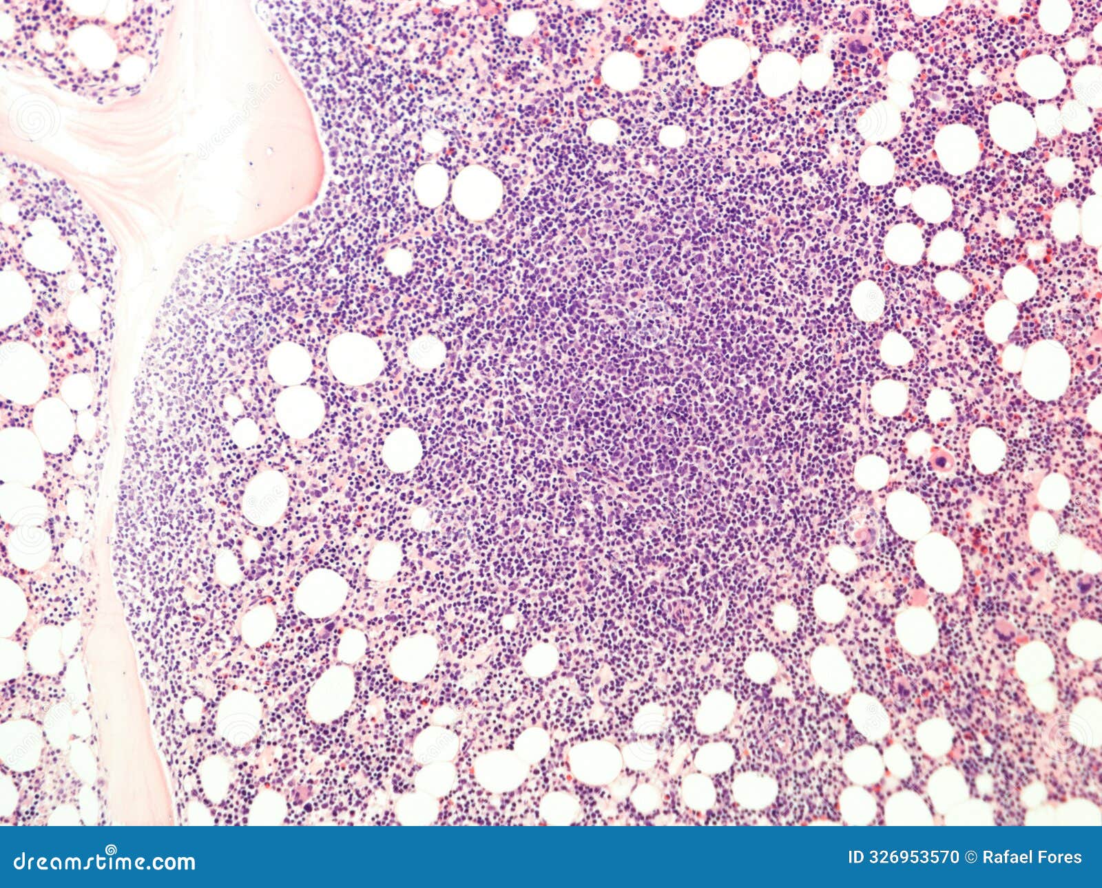 follicular lymphoma in bone marrow.