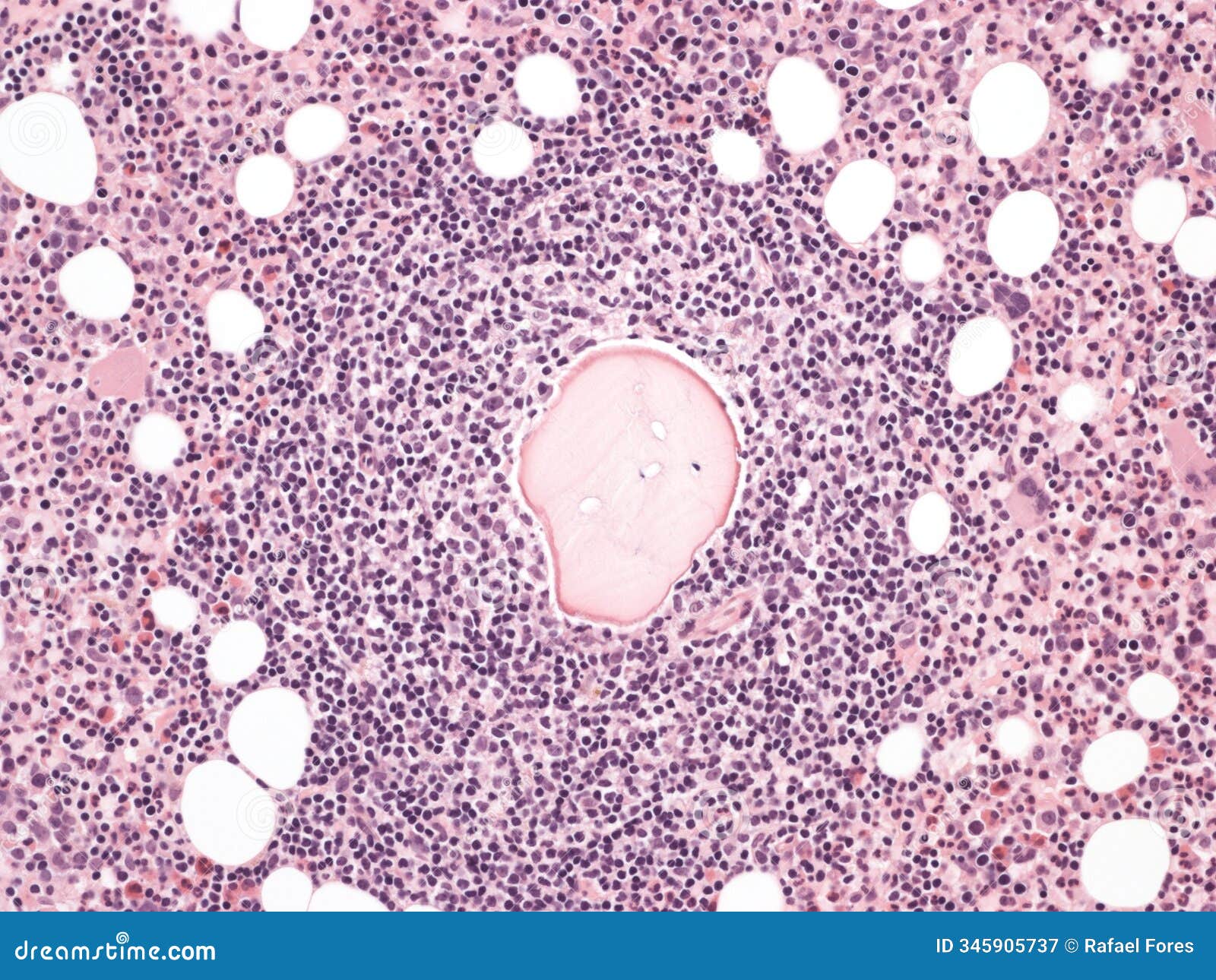 follicular lymphoma in bone marrow.
