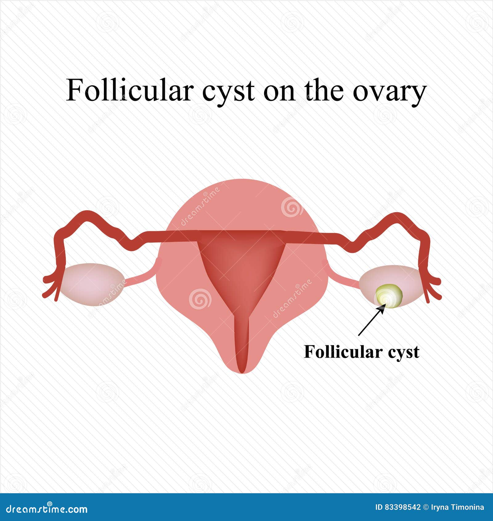 Ovarian Cyst Anatomy