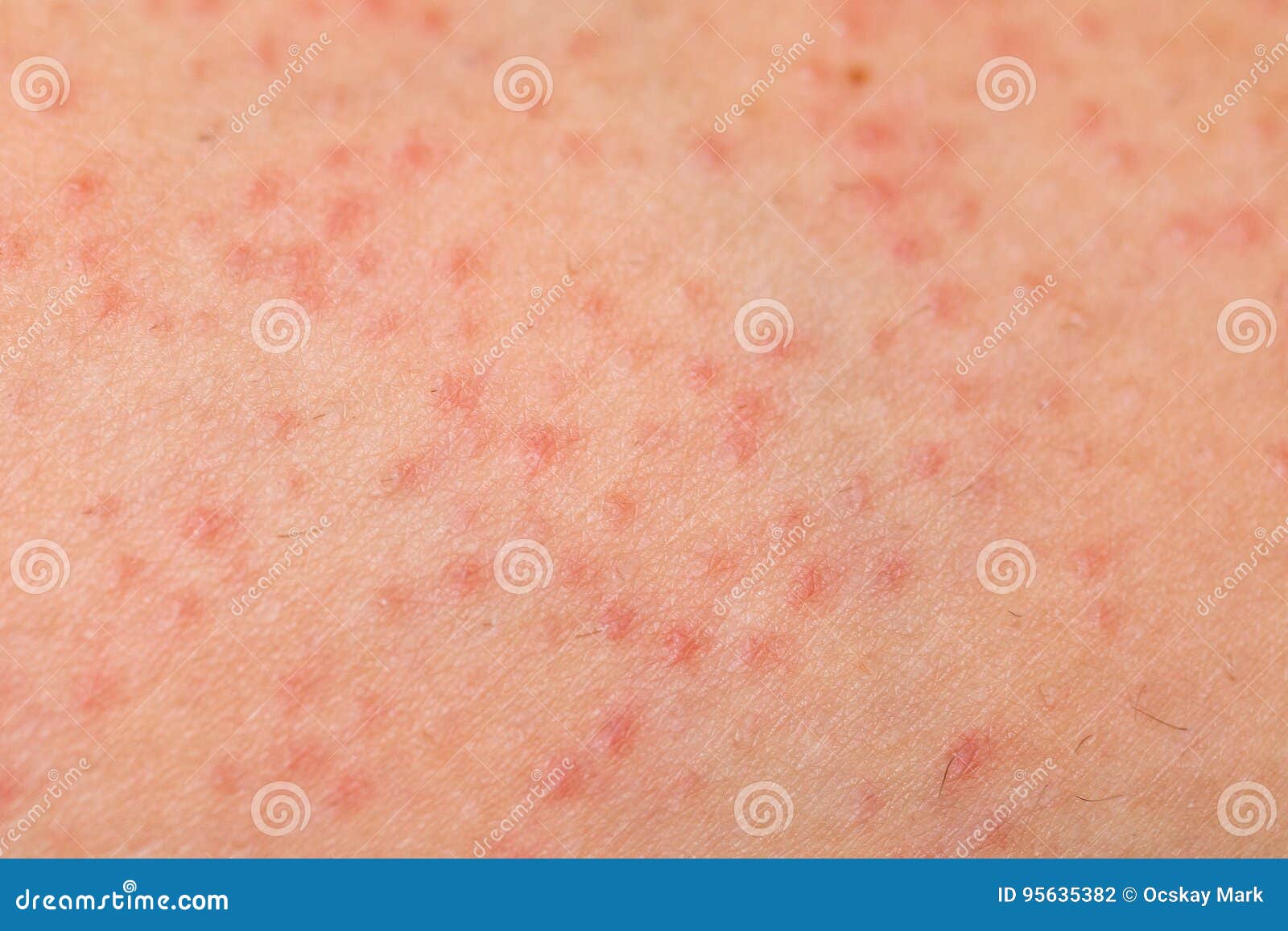 Pimple Folliculitis On Buttock Caused By Infection From Bacteria, Yeast