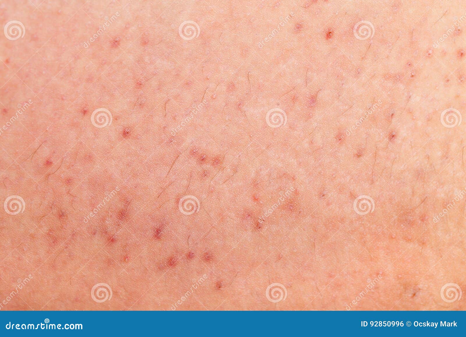 Pimple Folliculitis On Buttock Caused By Infection From Bacteria, Yeast