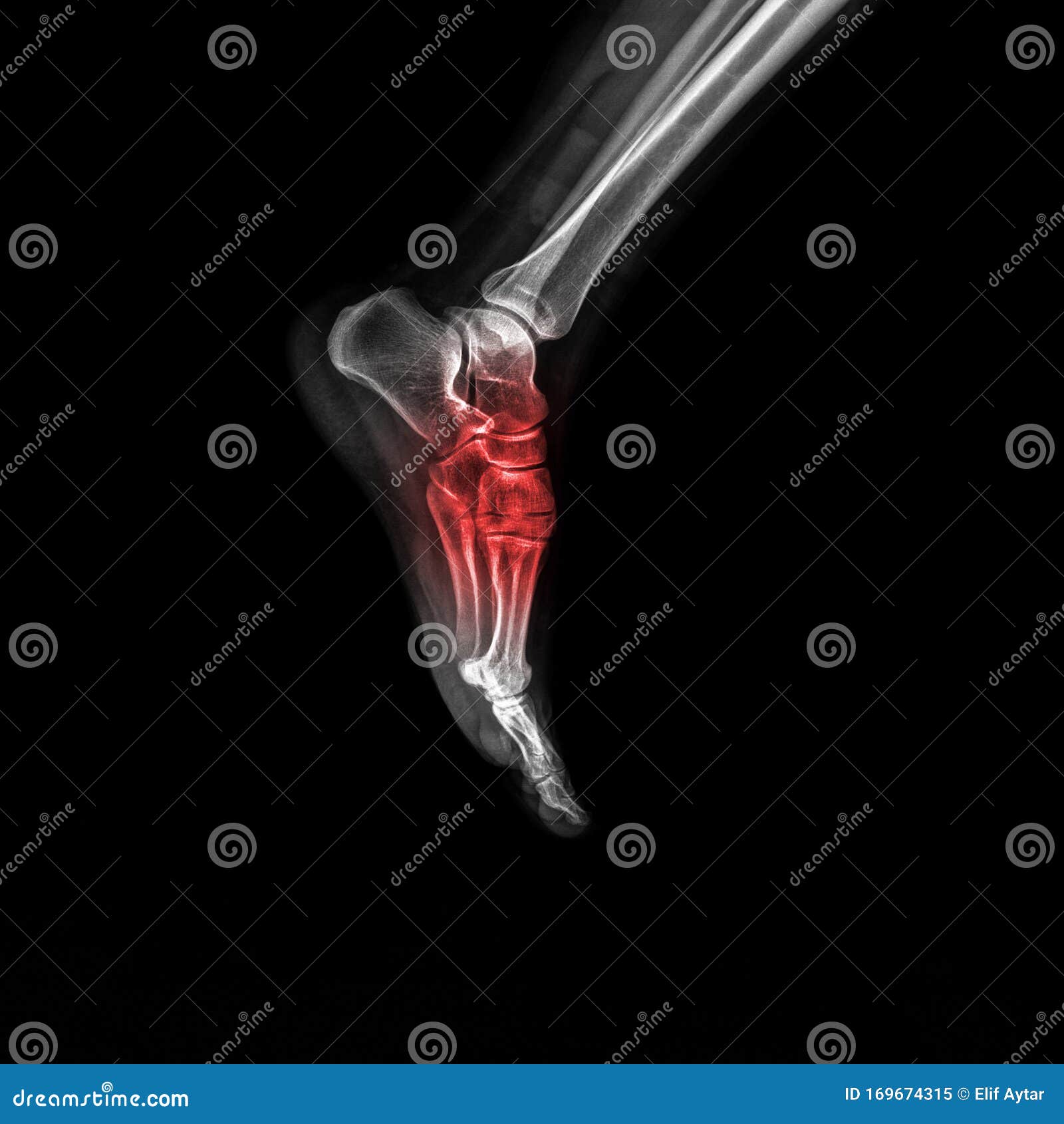Foot And Ankle Pain On Xray, Isolated On Black Background Stock Image