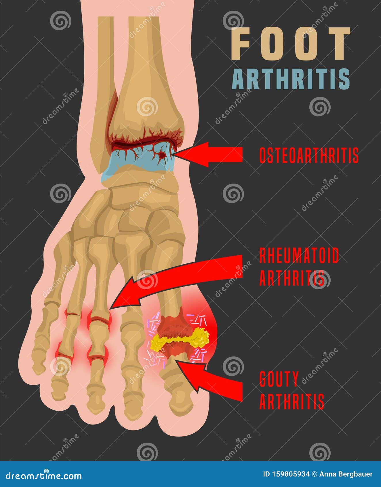 Arthritis Infographic Poster Vector Illustration | CartoonDealer.com ...