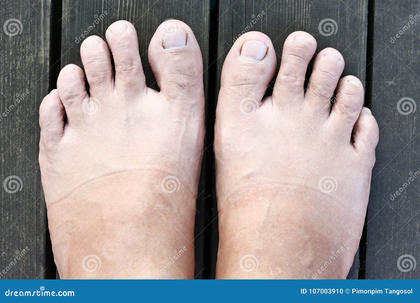 Foot Bacteria Stock Photos Download 405 Royalty Free Photos