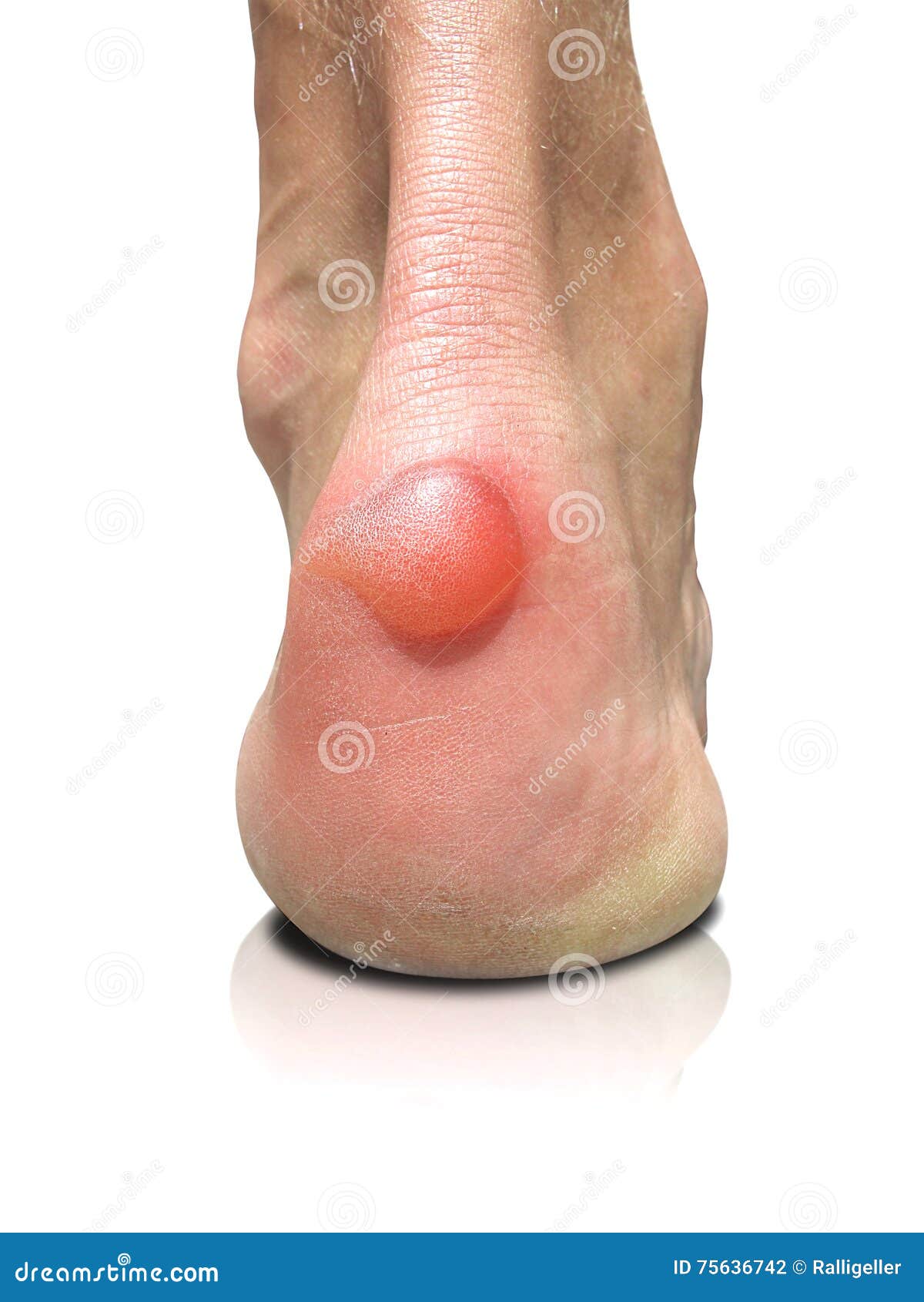 Foot with blister on heel stock photo. Image of painful 75636742