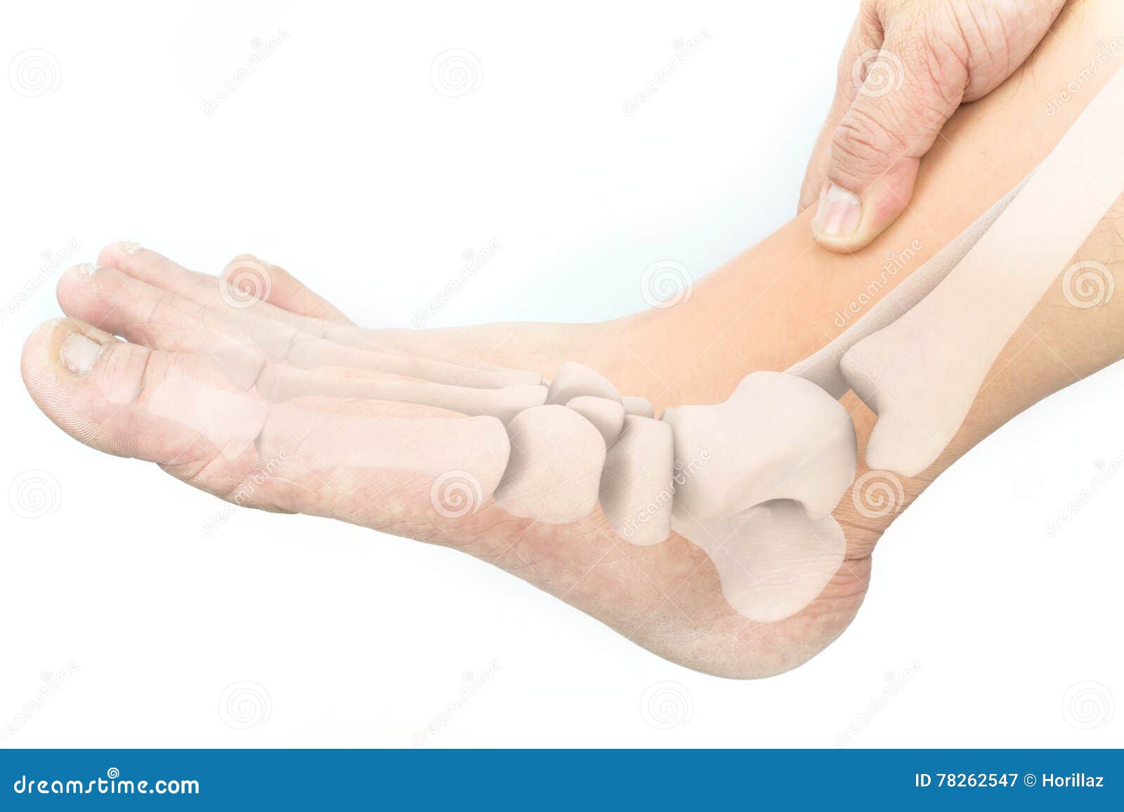 Foot bones injury stock image. Image of arthritis, gout 78262547
