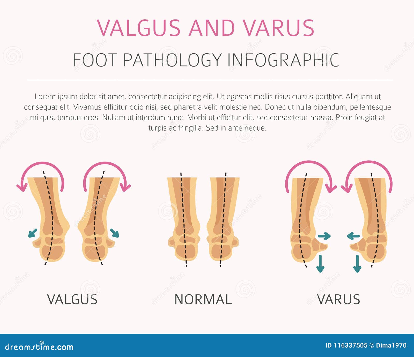 Varus Anatomy