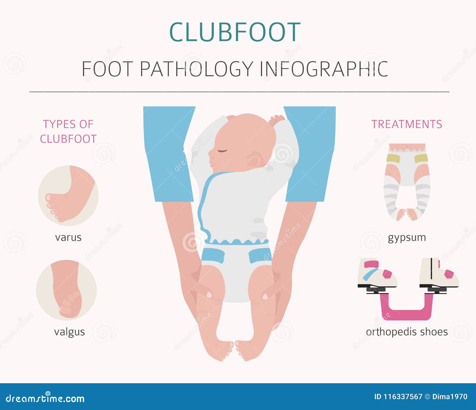 Clubfoot Stock Illustrations 96 Clubfoot Stock Illustrations Vectors Clipart Dreamstime