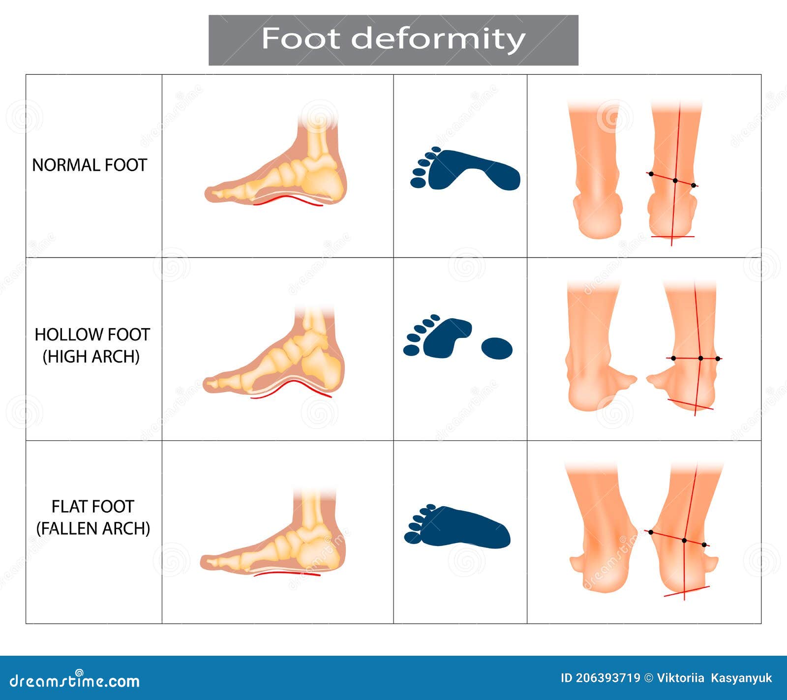 Hollow, Flat, And Normal Foot. Foot Deformity Types, Medical Disease ...