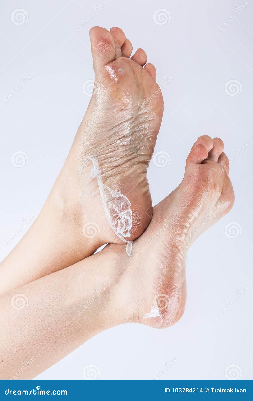 How to Prevent Cracked Heels? - Dr Venus