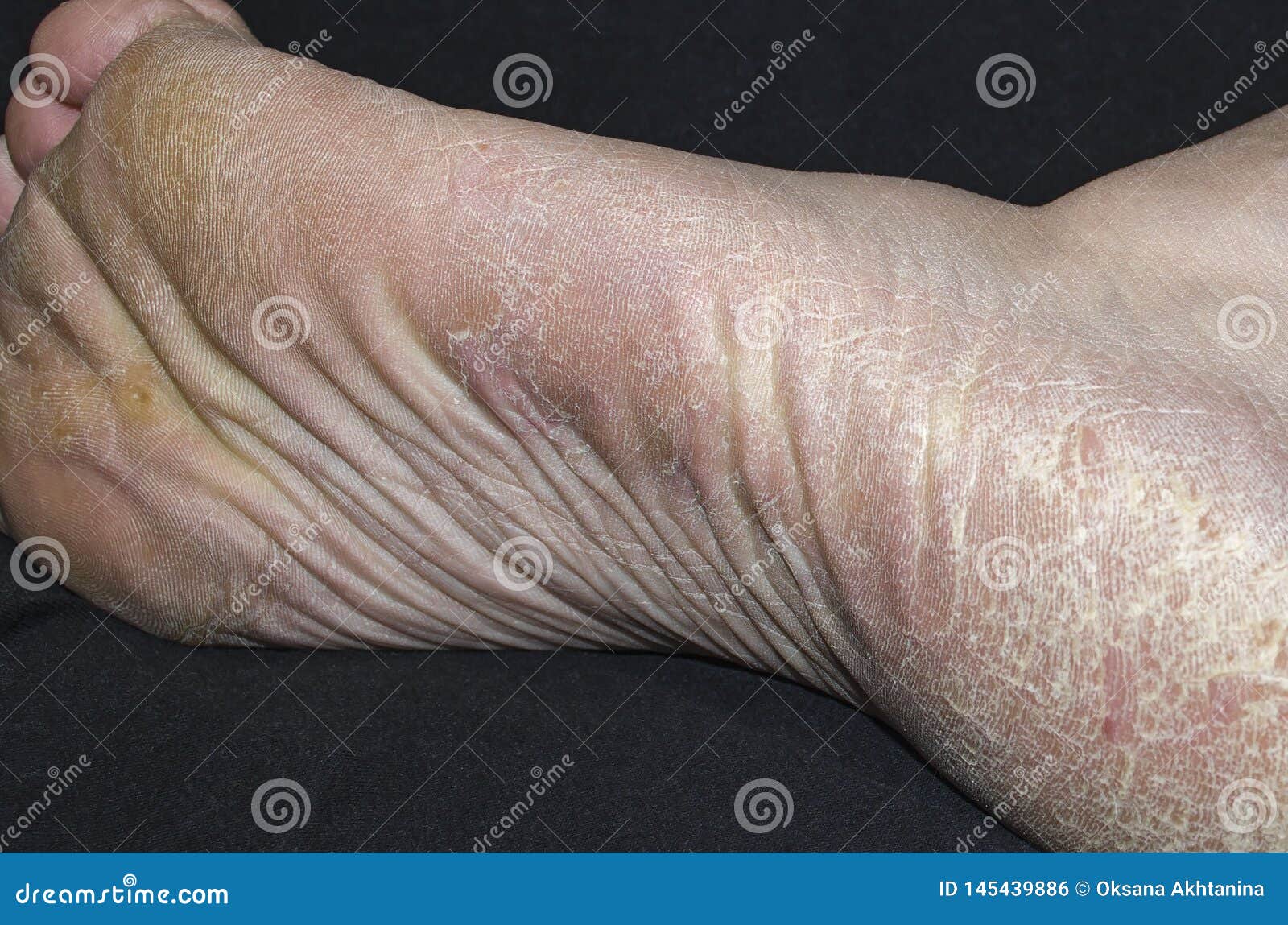 Callus And Hyperkeratosis On Feet Closeup Dried Skin Stock Photo