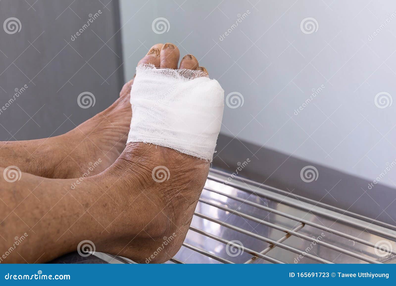 Foot infected wound stock image. Image of muscle, bacteria 165691723