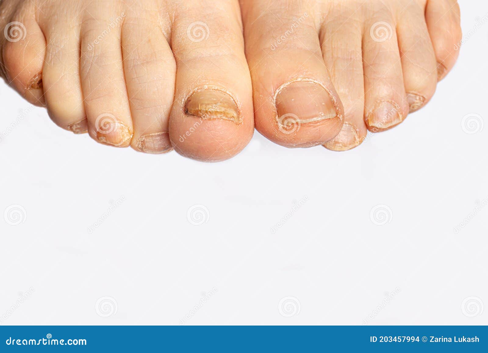 Foot Nail Fungus - a Comparison of Healthy and Sore Feet. Dermatomicosis  and Onyhomicosis, Fungal Infection Macro Photo with Place Stock Photo -  Image of barefoot, doctor: 203457994