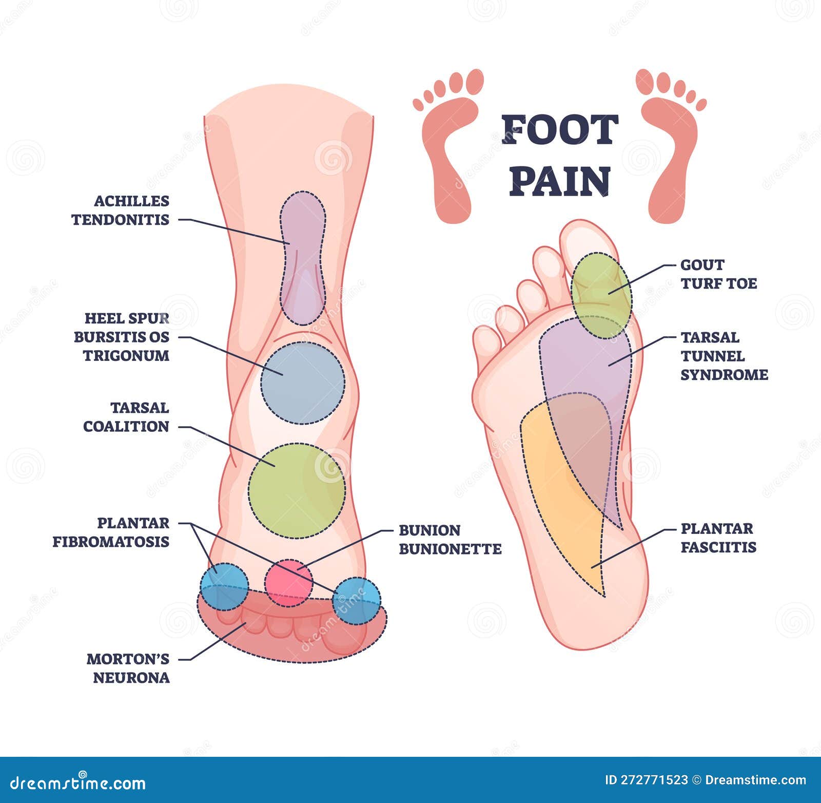 foot pain causes from zones diagnosis and painful spots areas outline diagram