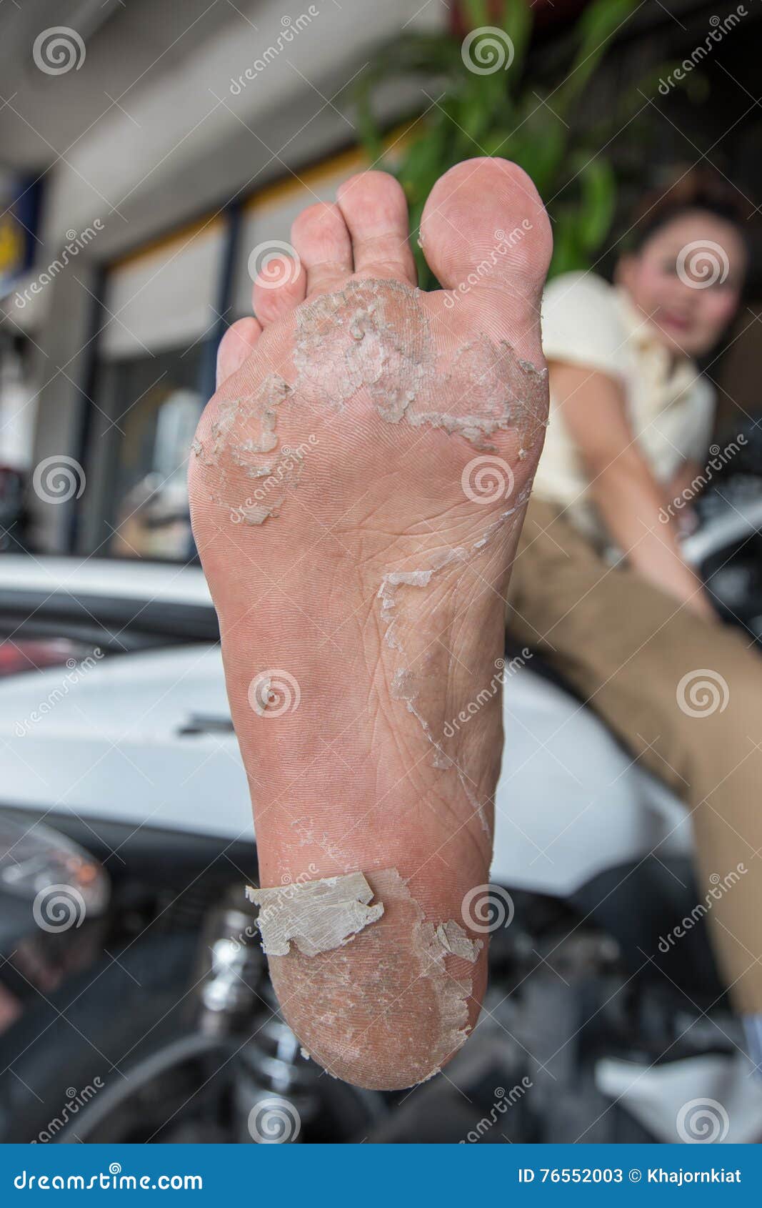 Foot peel stock image. Image of foot, crack, barefoot 76552003