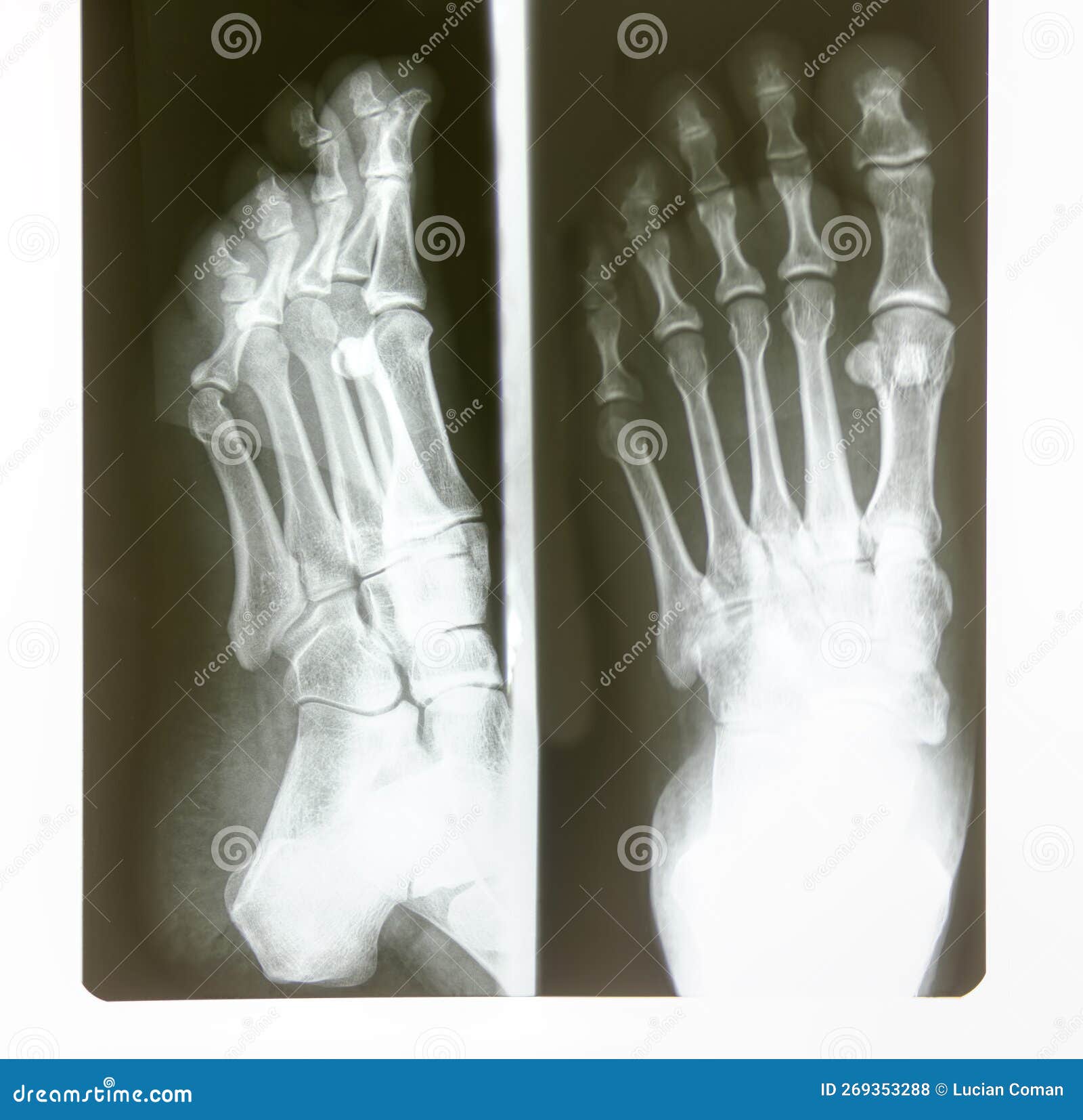 foot radiography black and white film roentgen