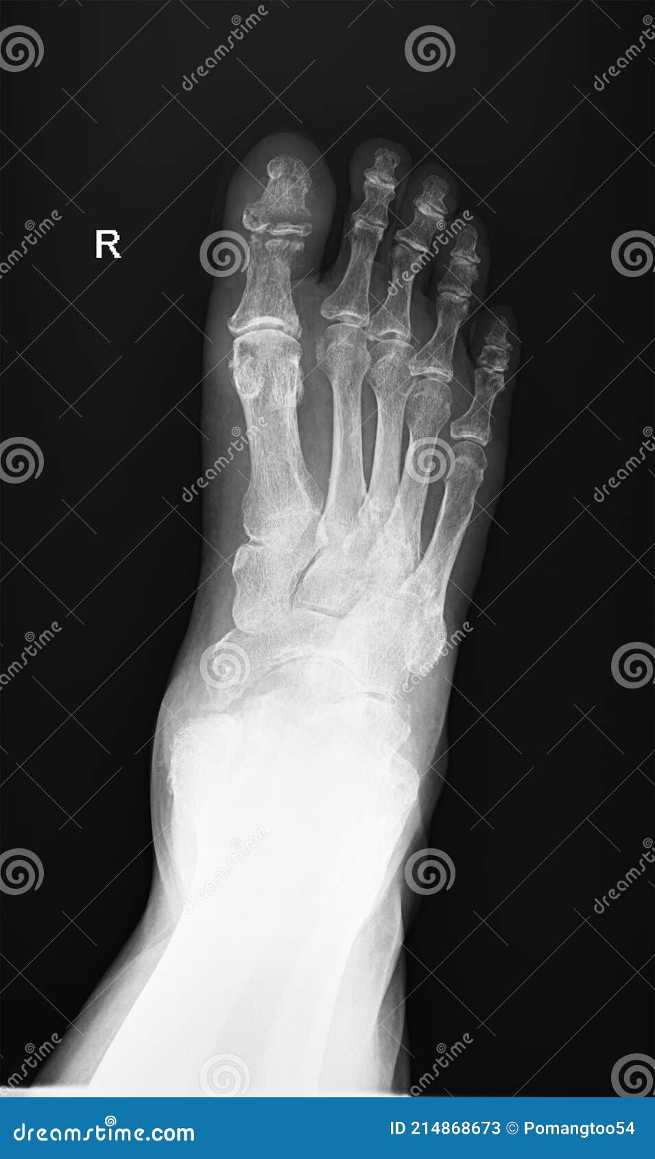 Foot Xray Image the Body of the Patient Stock Image Image of joint