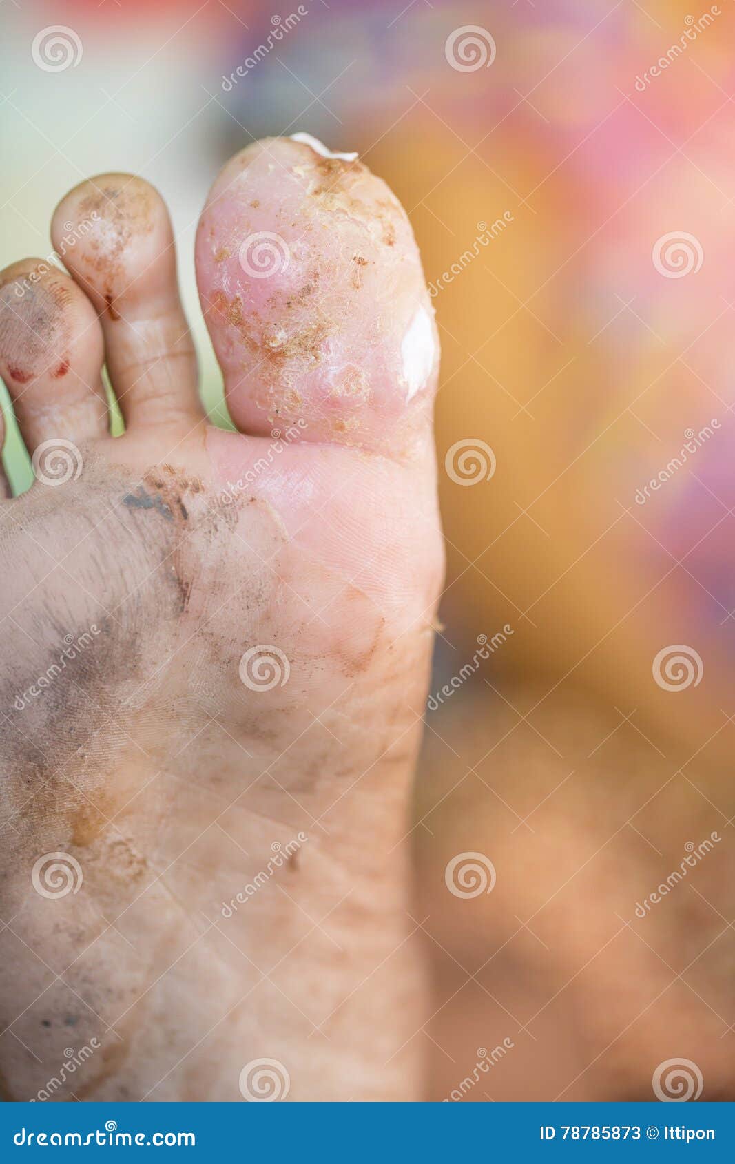 Foot ulcers from diabetes stock image. Image of hurt 78785873