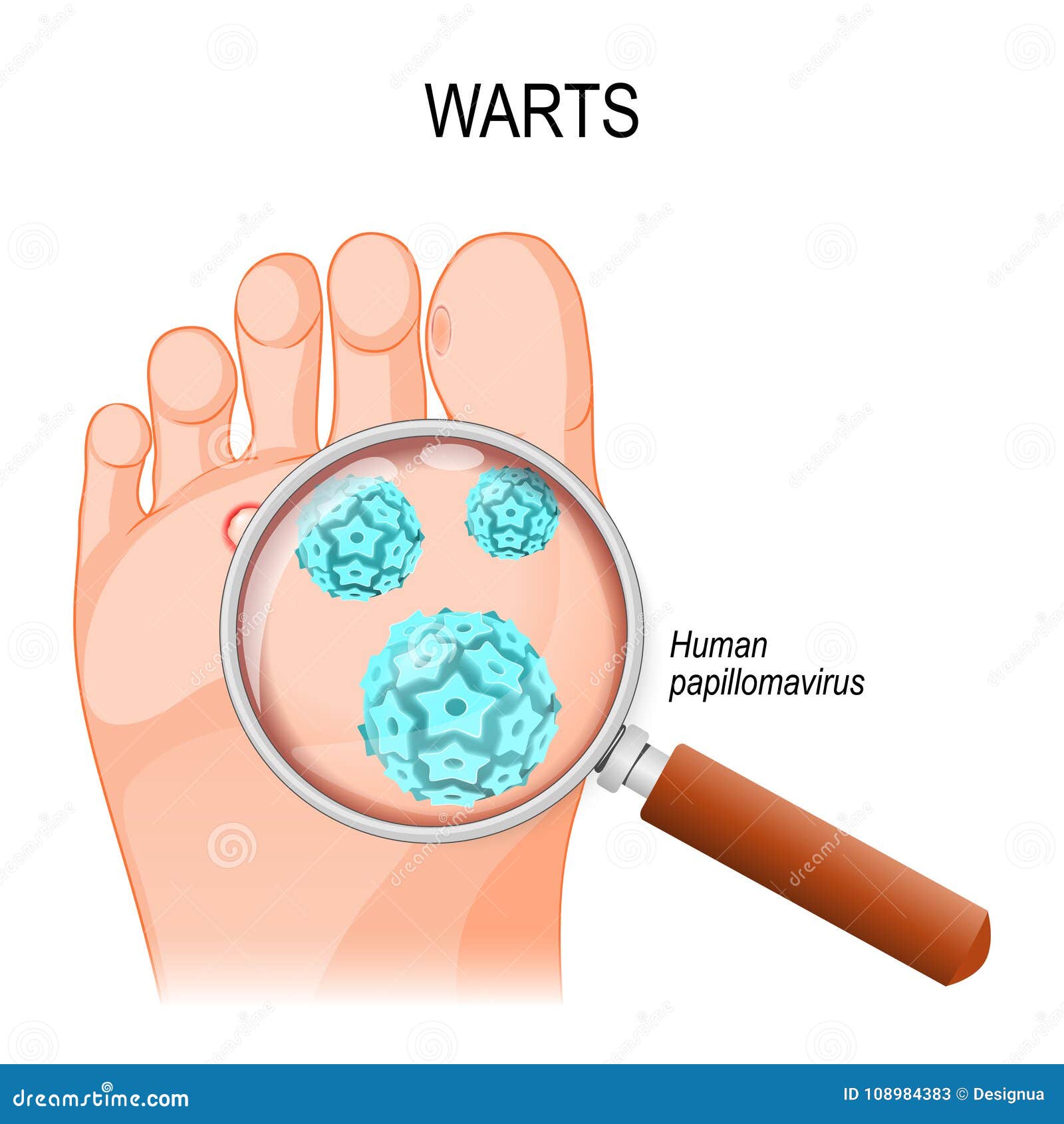 Hpv that causes warts on feet. Hpv foot wart treatment Hpv virus and warts on feet