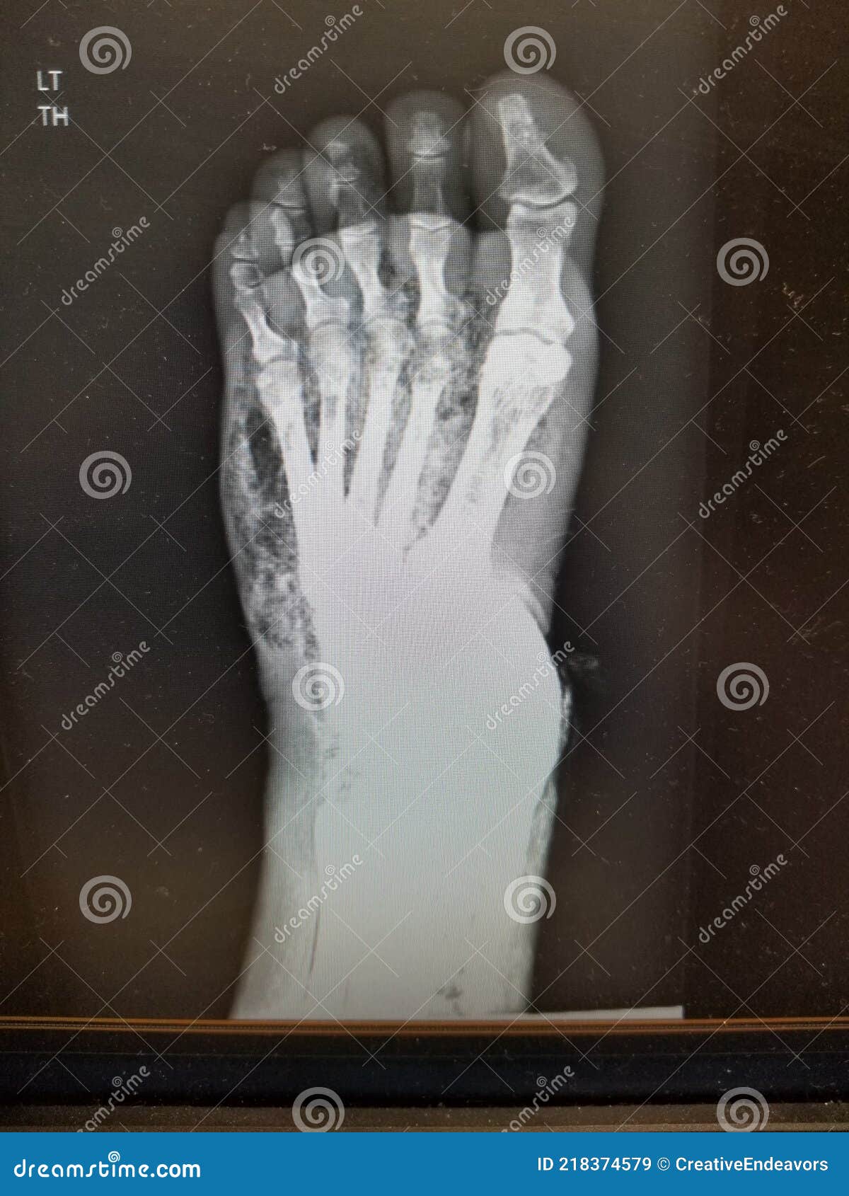 Foot Xray Showing Soft Tissue Gas in Patient with Necrotizing
