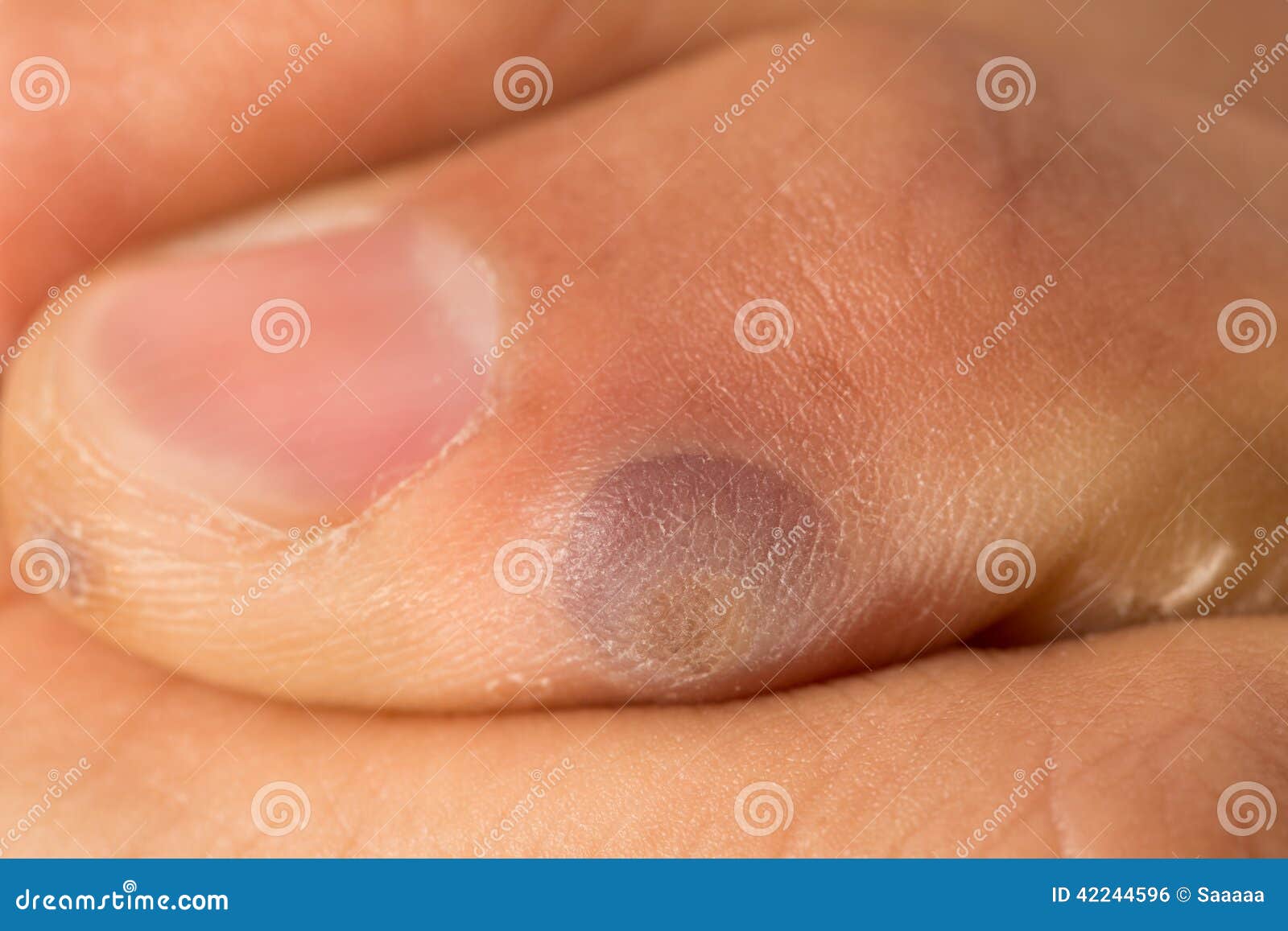 Difference Entre Cor Et Verrue Formation De Verrue Et De Boursouflure Après Avoir été Gelé Photo stock