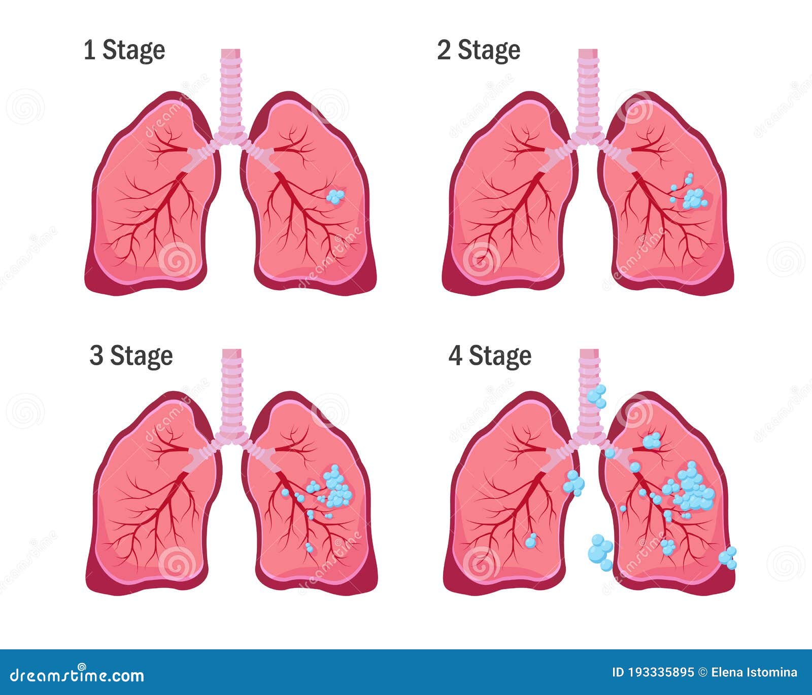 Lung Cancer Concept Map