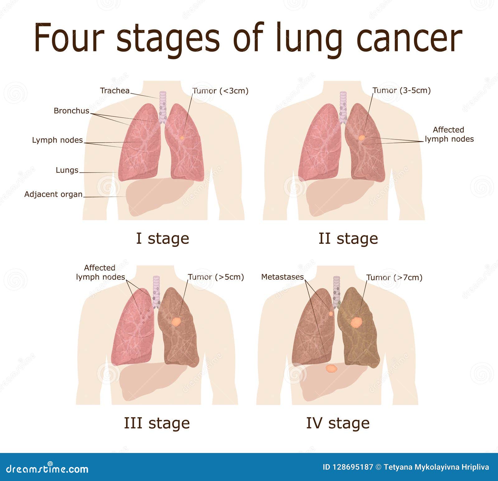 Four Stages Of Lung Cancer Stock Vector Illustration Of Genetics