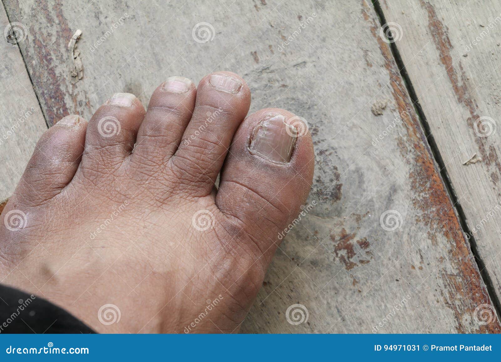 Foyer Selectif De Gros Orteil Invetere De Clou Ongle De Pied Casse Sur F En Bois Image Stock Image Du Humain Infection Foyer Selectif De Gros Orteil Invetere De Clou Ongle De Pied Casse Sur F En Bois Image Stock Image Du Humain Infection