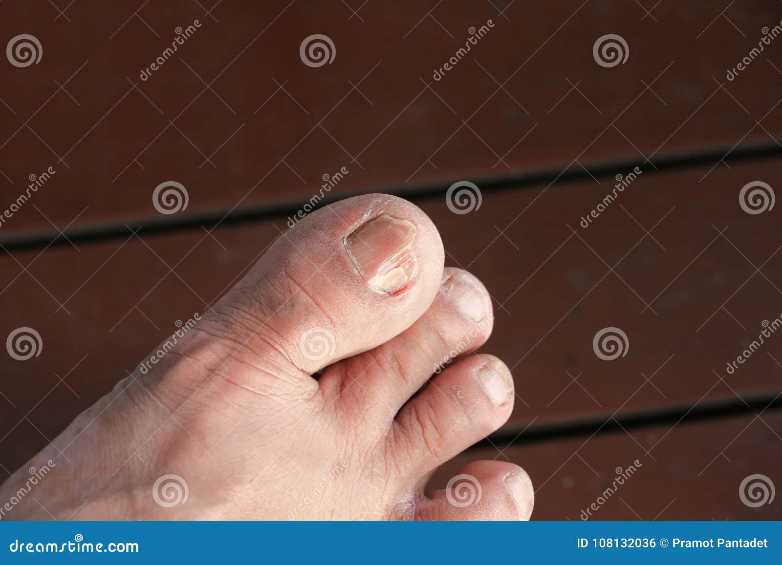 Foyer Selectif De Gros Orteil Invetere De Clou Ongle De Pied Casse Sur Le Plancher En Bois Photo Stock Image Du Medical Mycete Foyer Selectif De Gros Orteil Invetere De Clou Ongle De Pied Casse Sur Le Plancher En Bois Photo Stock Image Du Medical Mycete