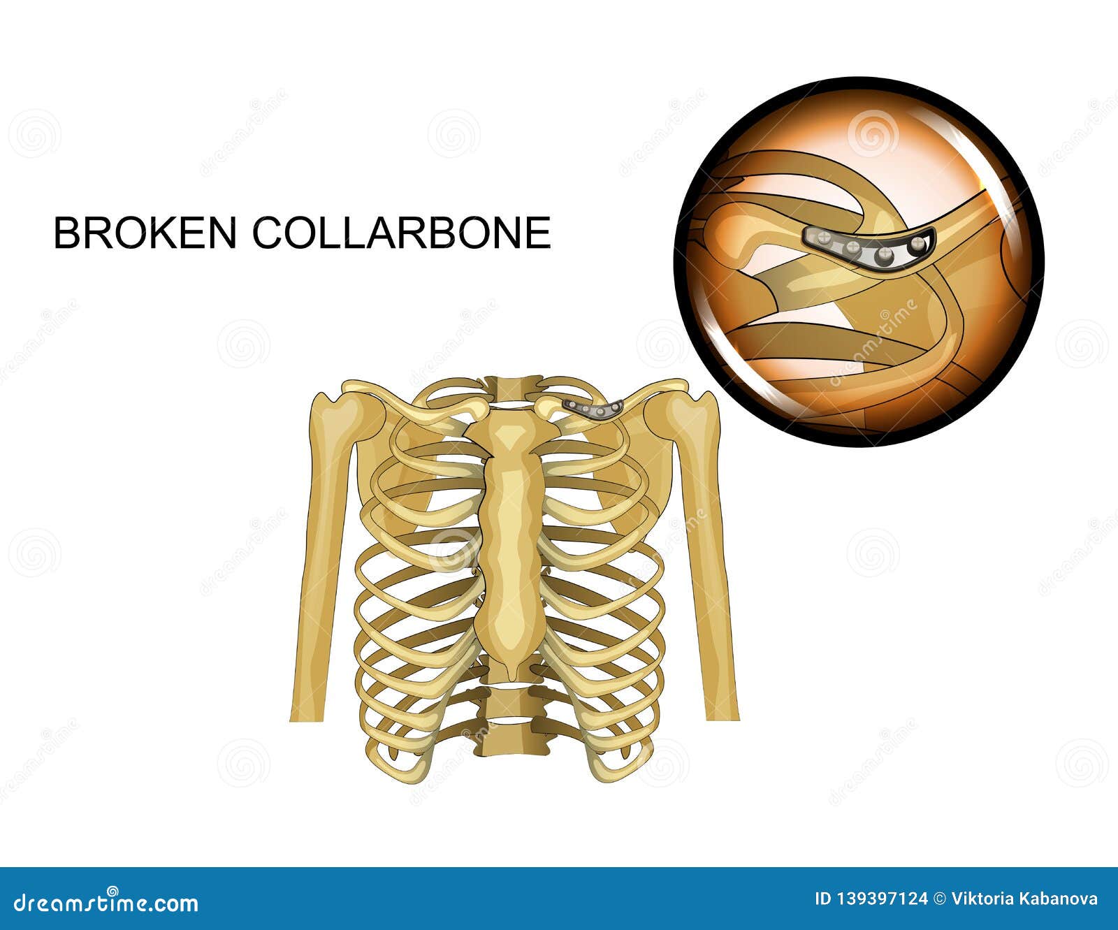 Fracture of the Clavicle. Osteosynthesis Stock Vector Illustration of