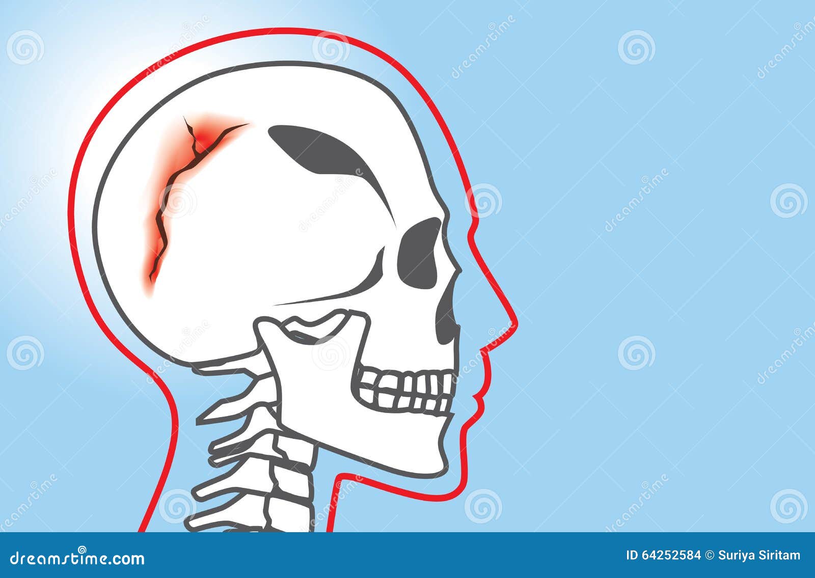 Fracture de crâne illustration de vecteur. Illustration du visage ...