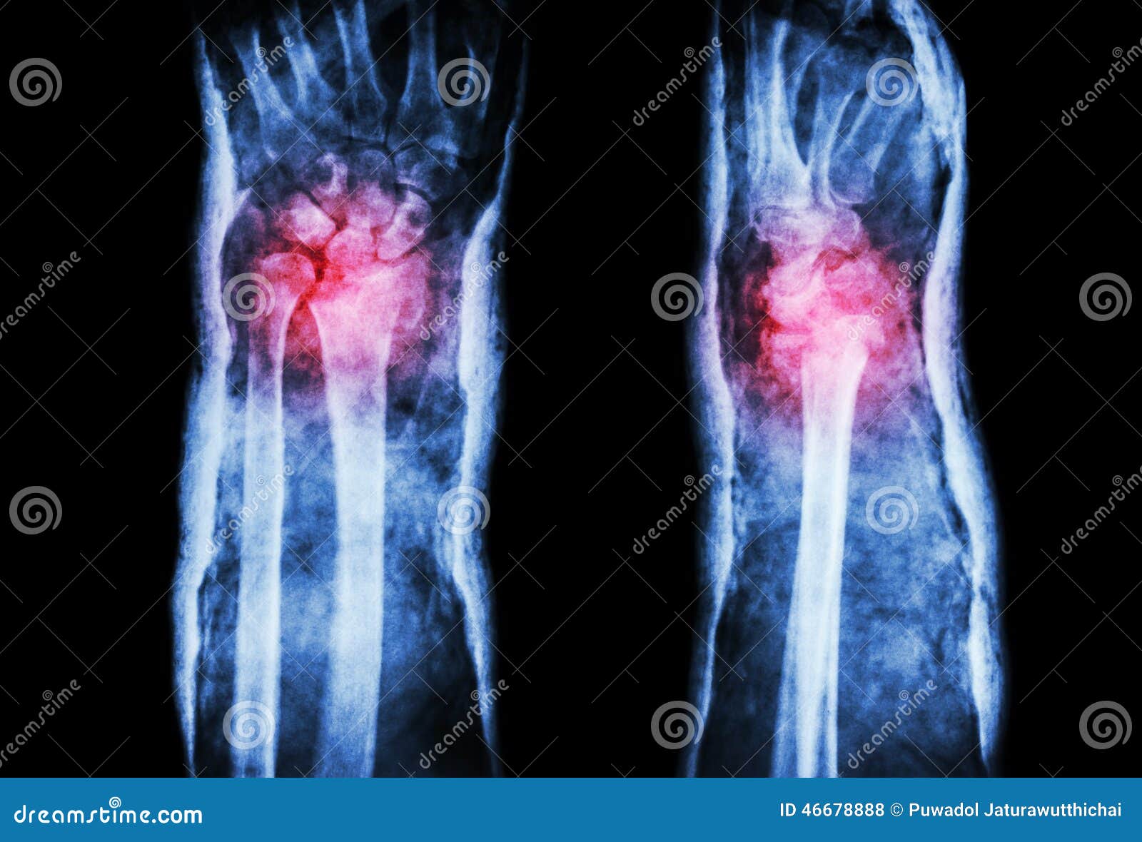 fracture distal radius (colles' fracture) and cast