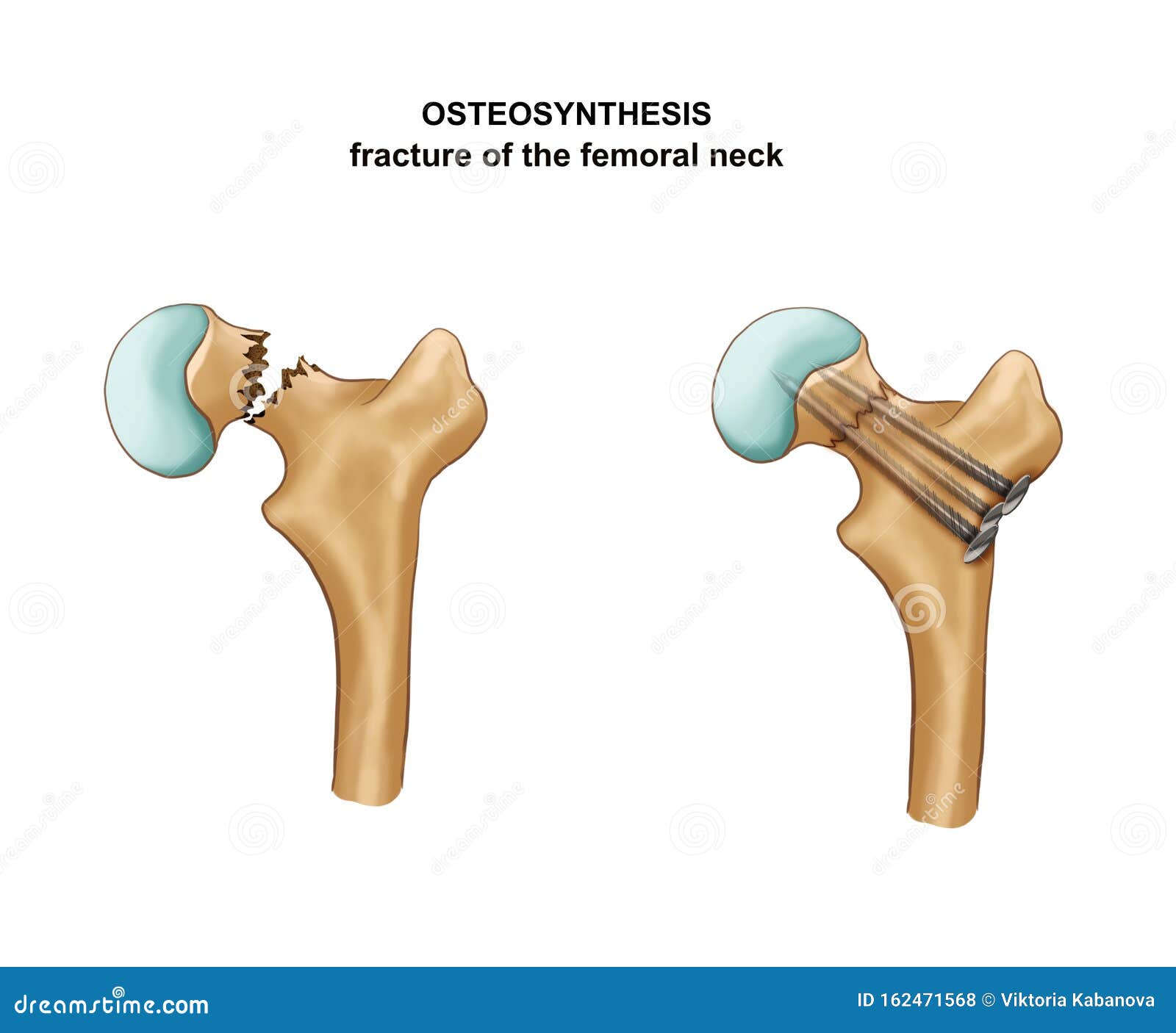 fracture of the femoral neck. osteosynthesis