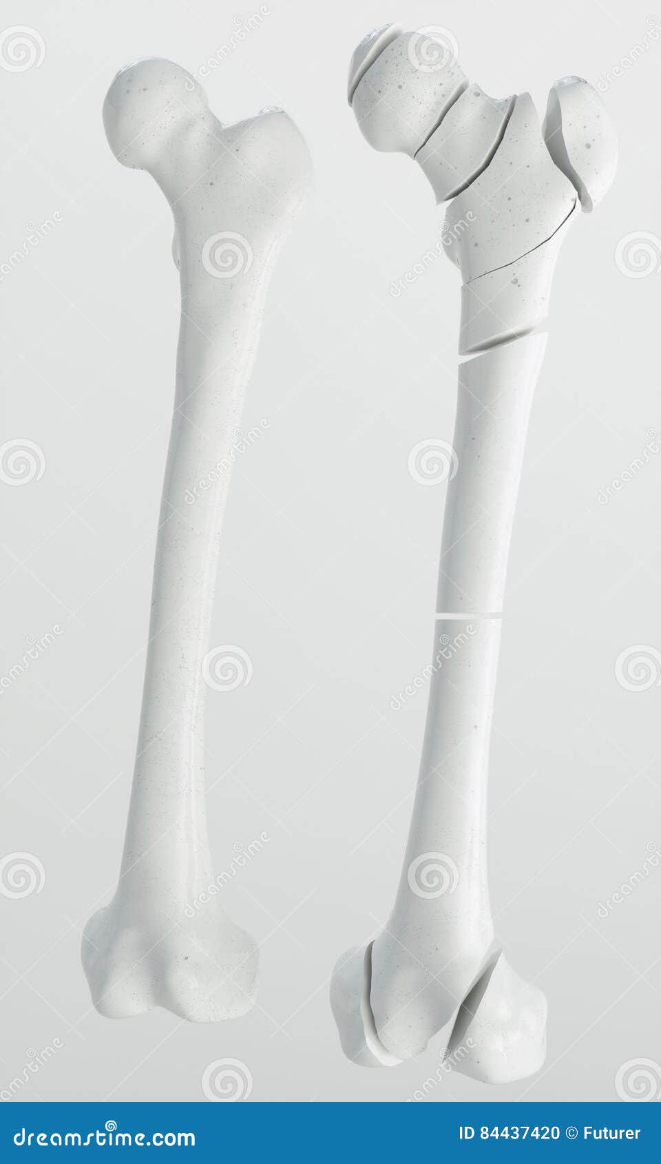 fracture of the femur - breakpoints - 3d rendering