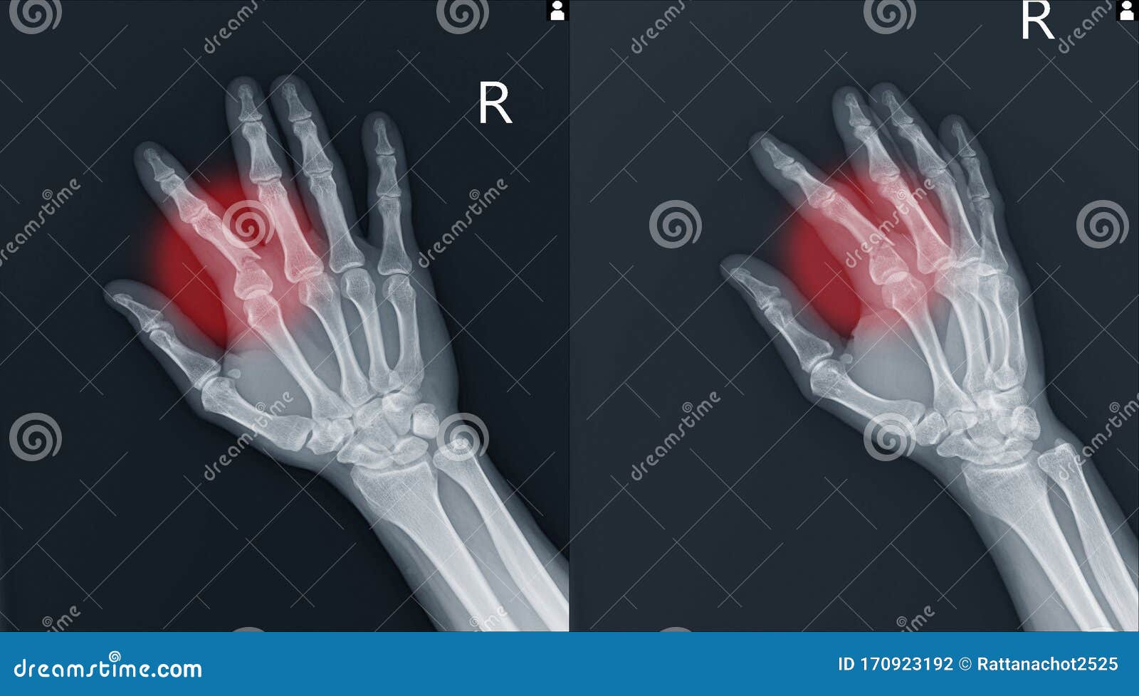 fracture index proximal phalanx showing x-ray hand.