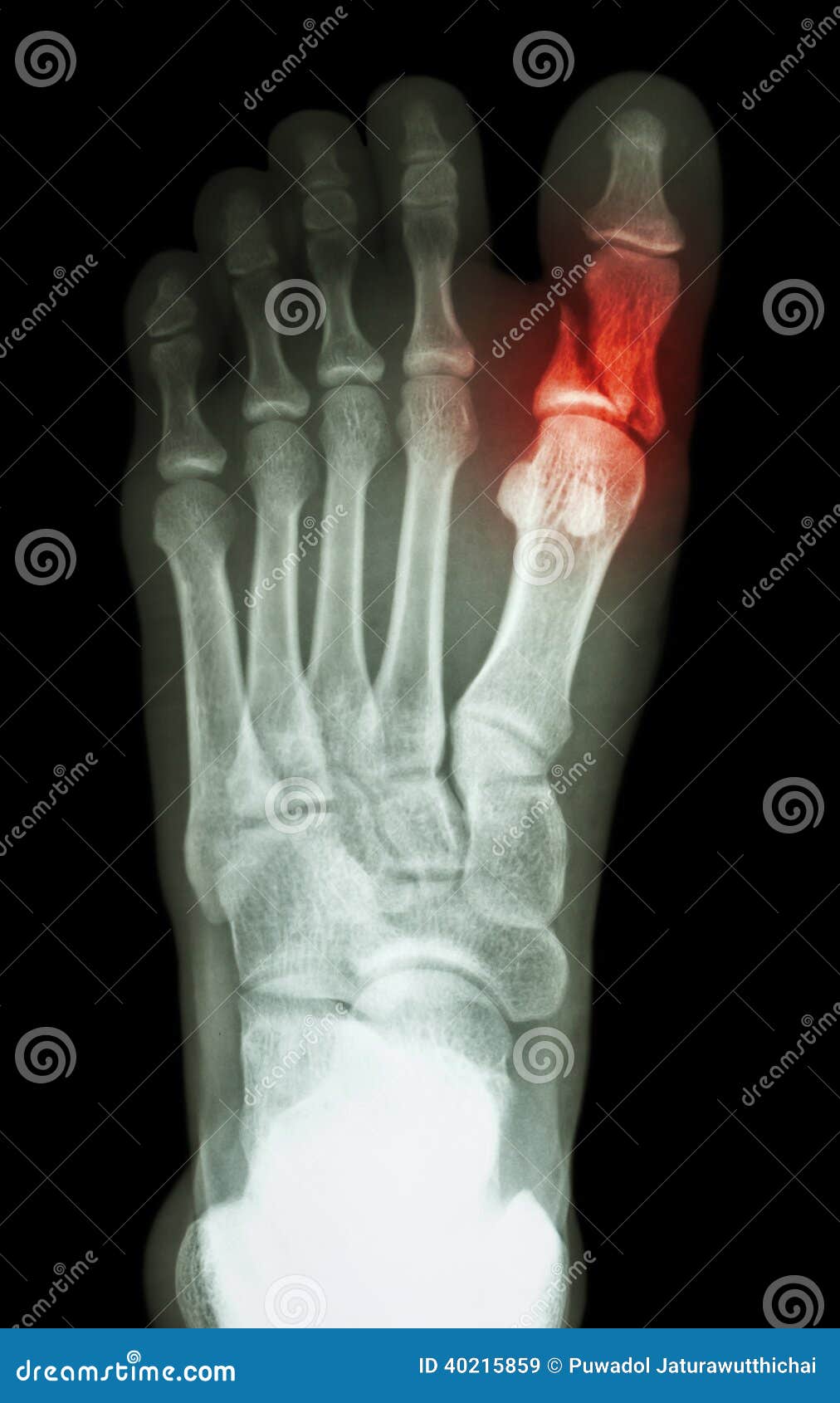 fracture proximal phalange at first toe