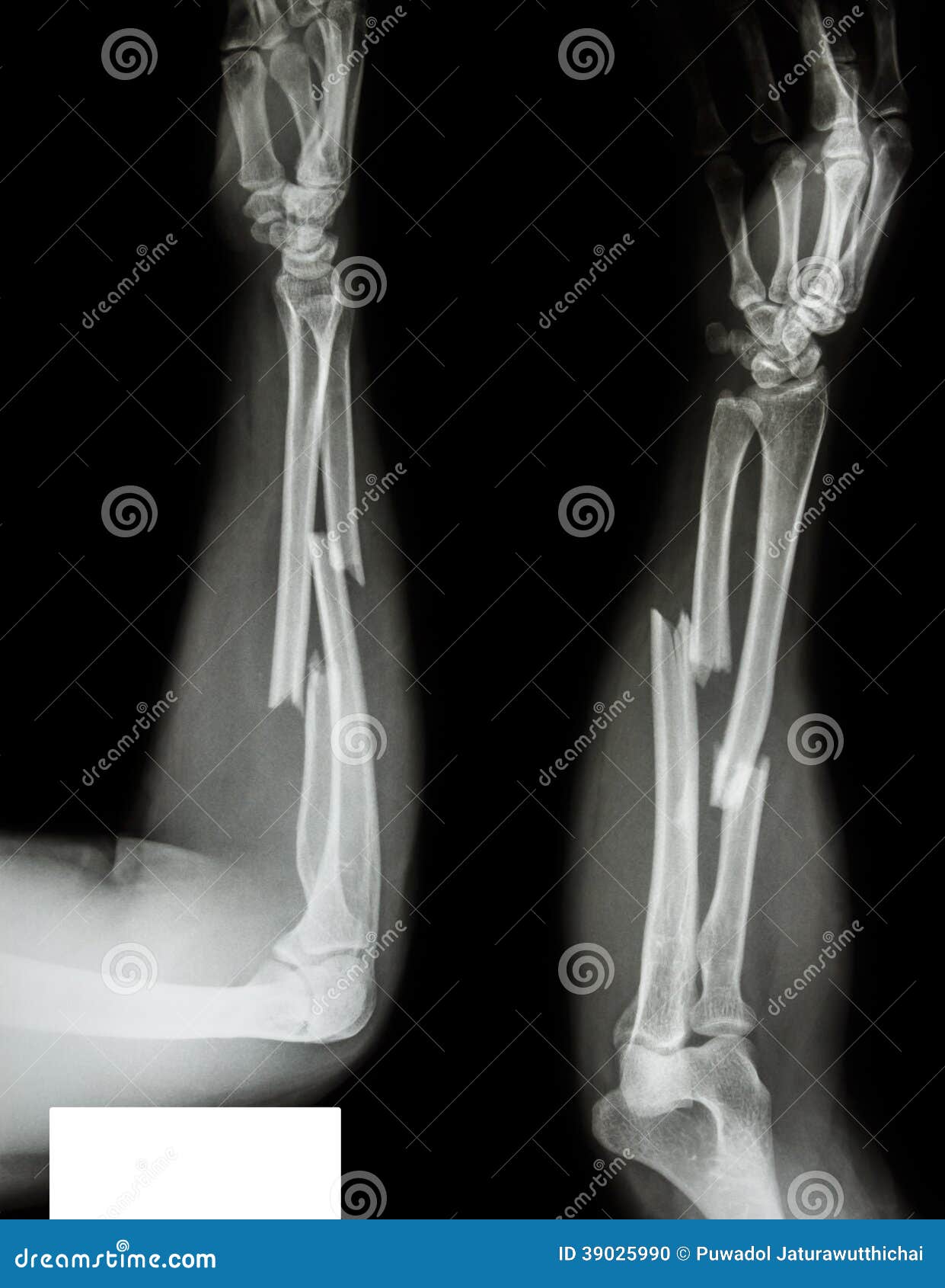 fracture radius & ulnar bone