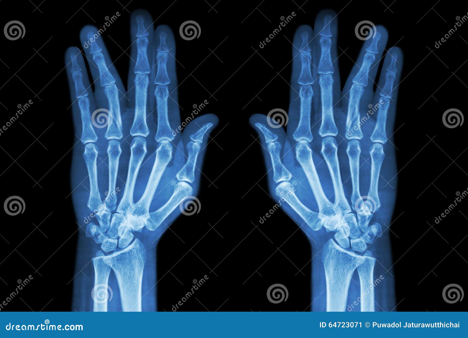 fracture shaft of proximal phalange of ring finger ( film x-ray both hand ap )