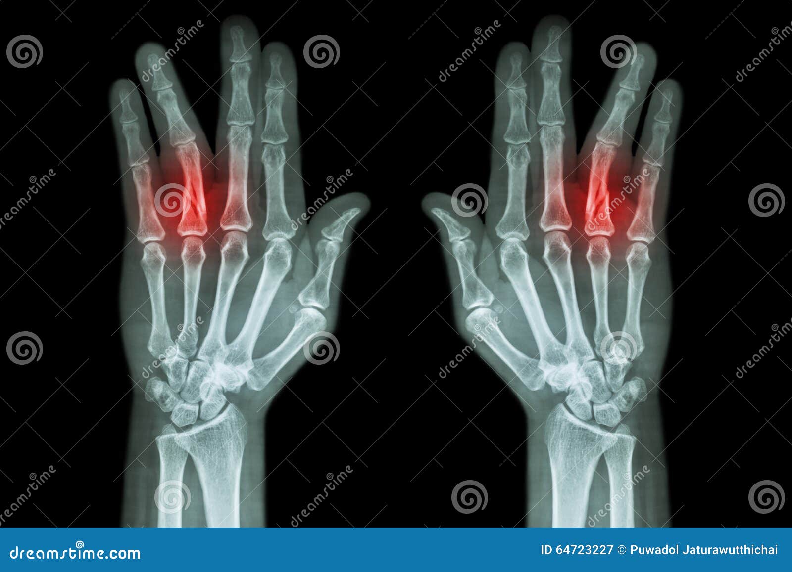 fracture shaft of proximal phalange of ring finger ( film x-ray both hand ap )