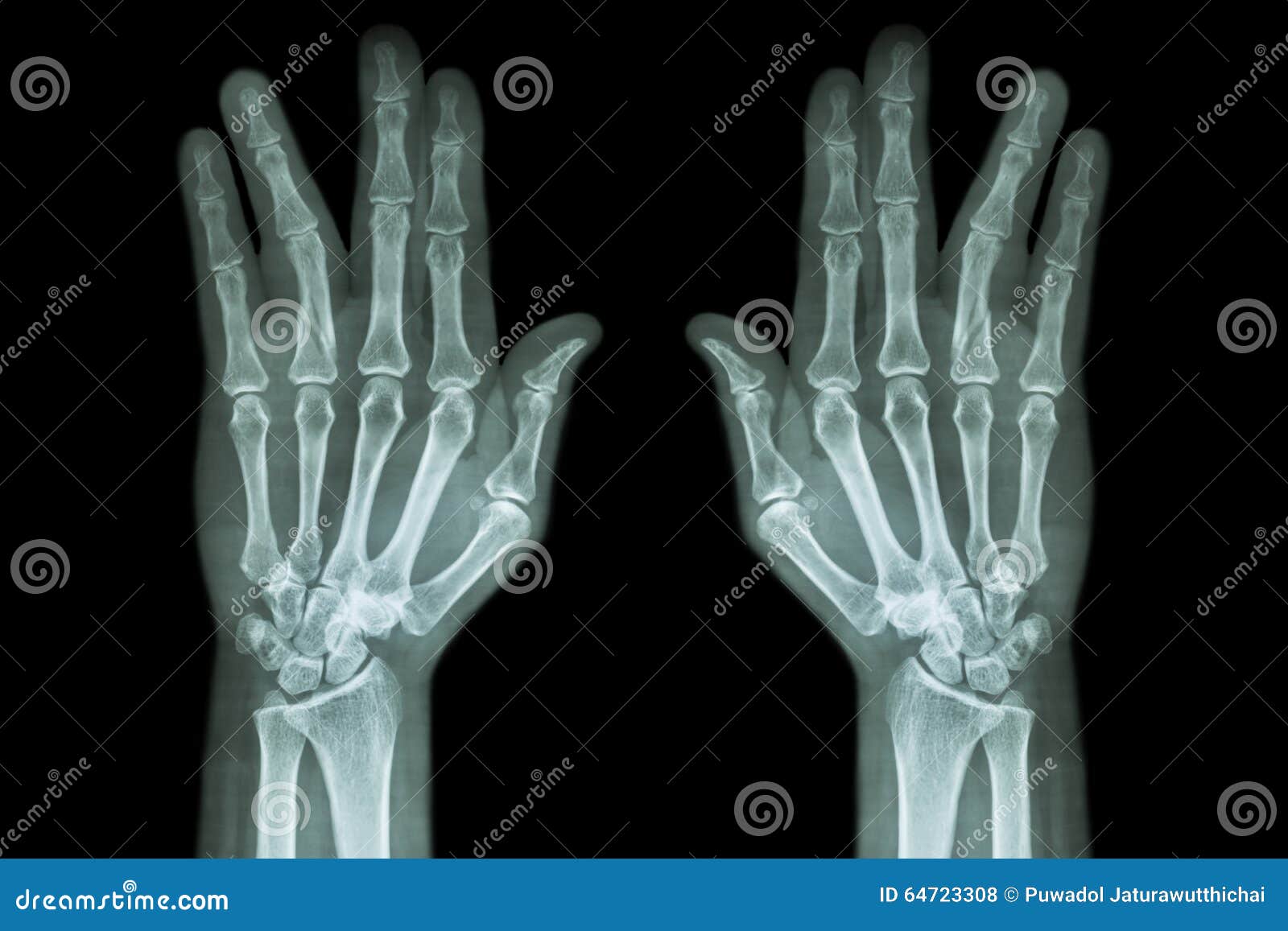 fracture shaft of proximal phalange of ring finger ( film x-ray both hand ap )