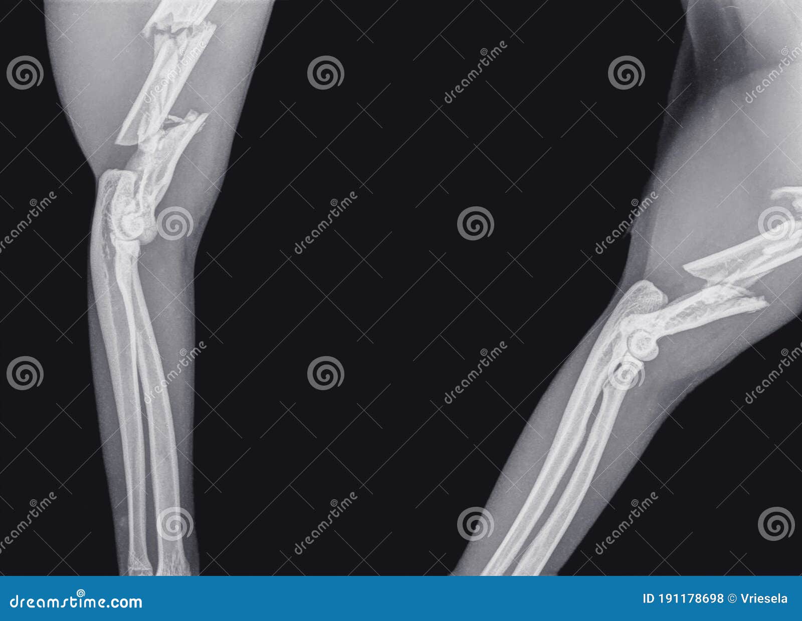 Fracture of the Upper Arm Bone Humerus of a Cat Stock Photo Image of