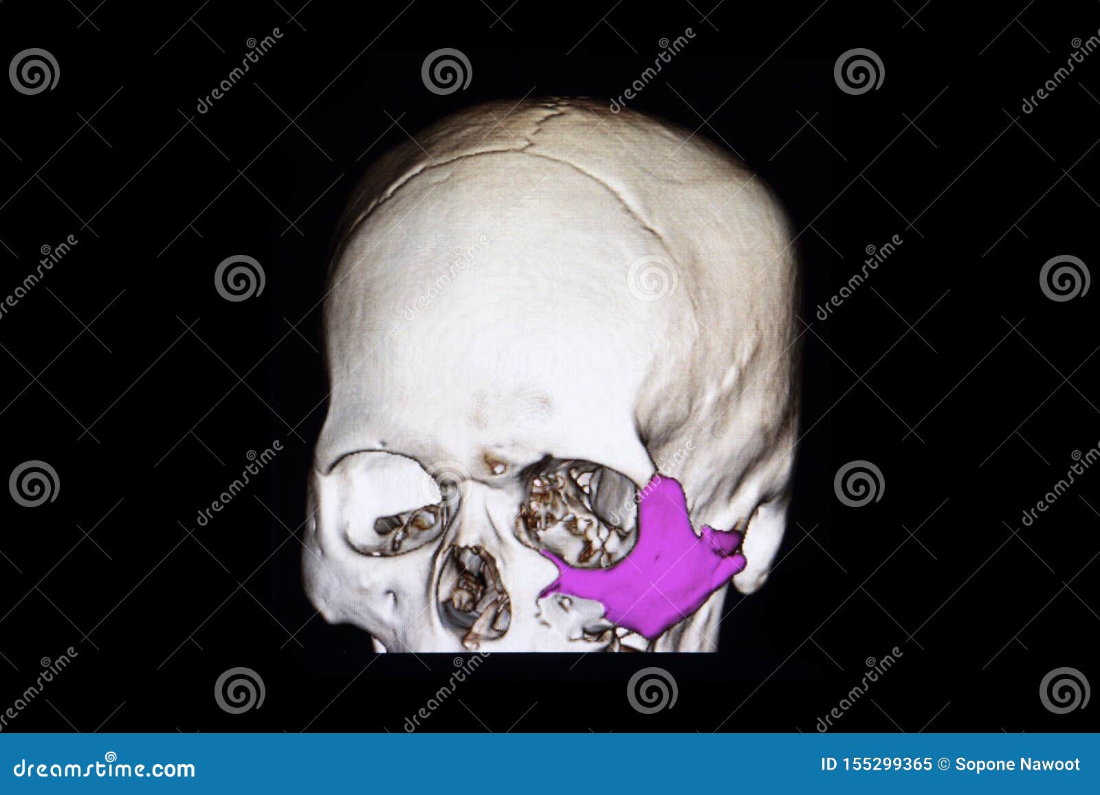 Fracture Zygoma And Floor Of Orbit Stock Image Image Of Contrast