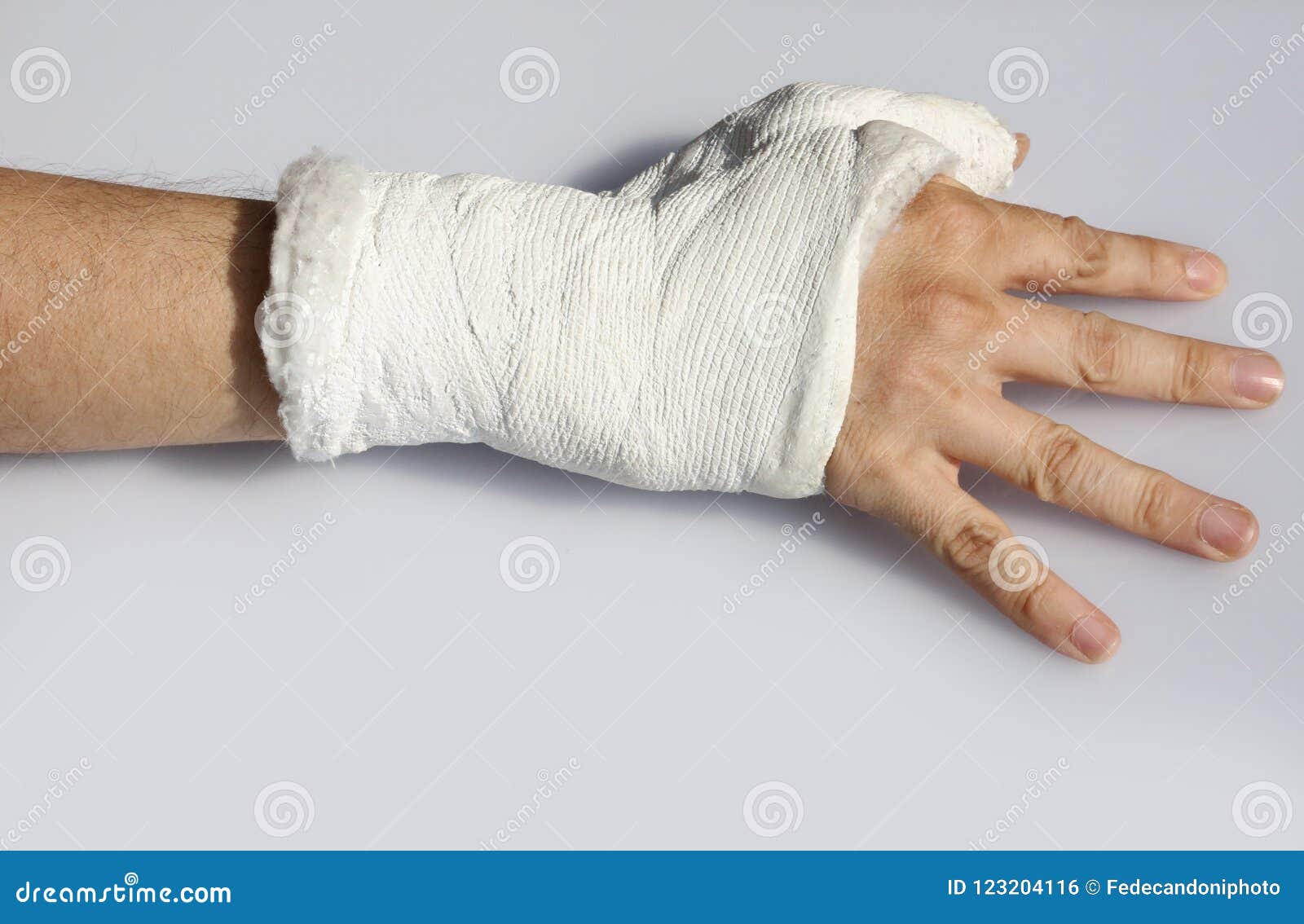 Hand Cast Fractured after an Accident Stock Photo - Image of hand