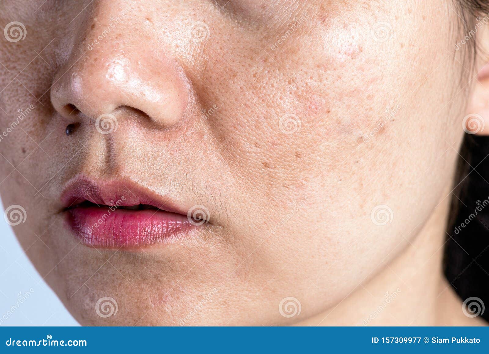 Frauen Mit Problematischen Haut Und Akne Narben Problembehandlung Und Gesundheitskonzept Falten Melasma Dunkle Flecken Freckeln Stockbild Bild Von Melasma Frauen