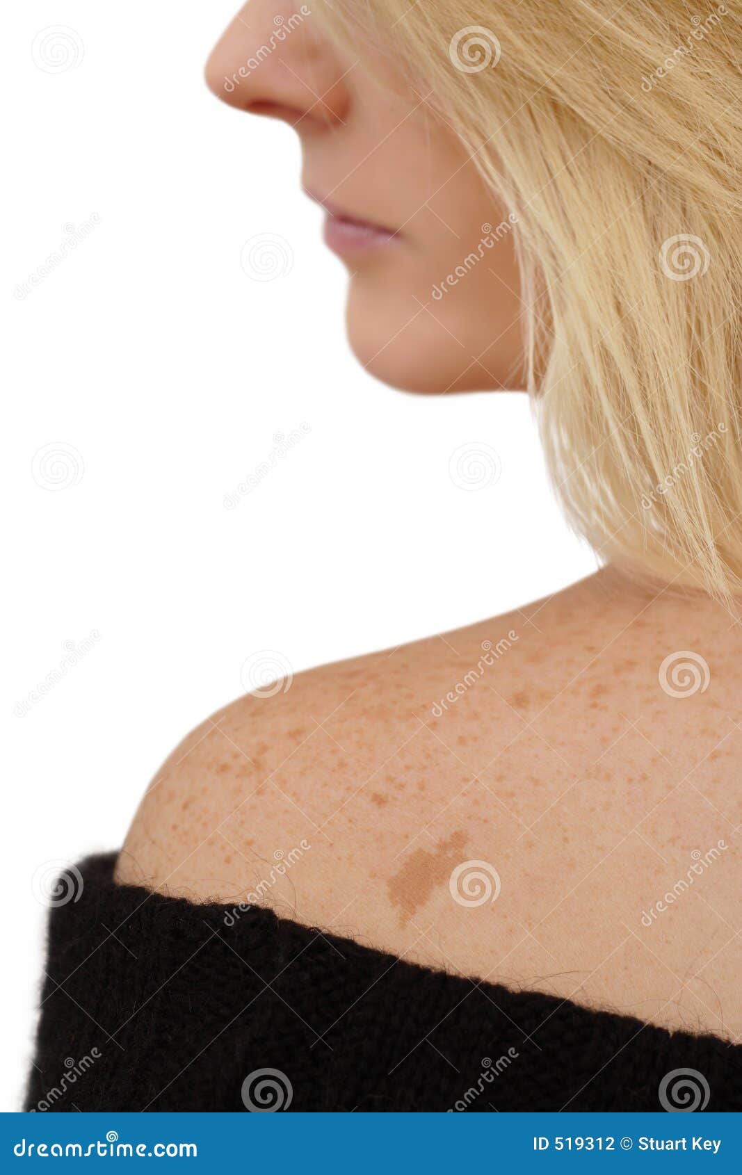 freckles & birth mark