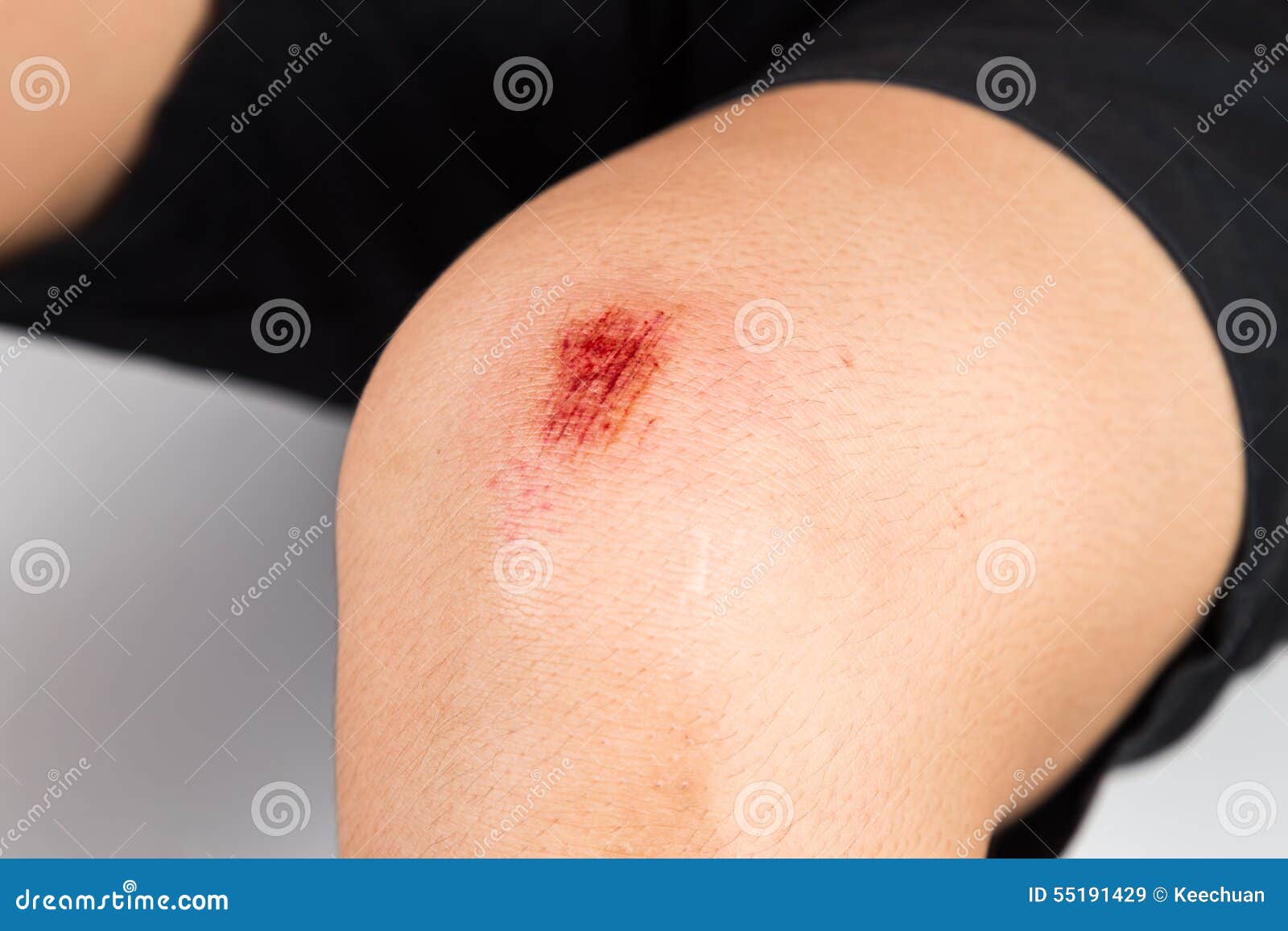 Fresh Bruise On White Skin. Painful Green Purple Huge Bruise On Leg