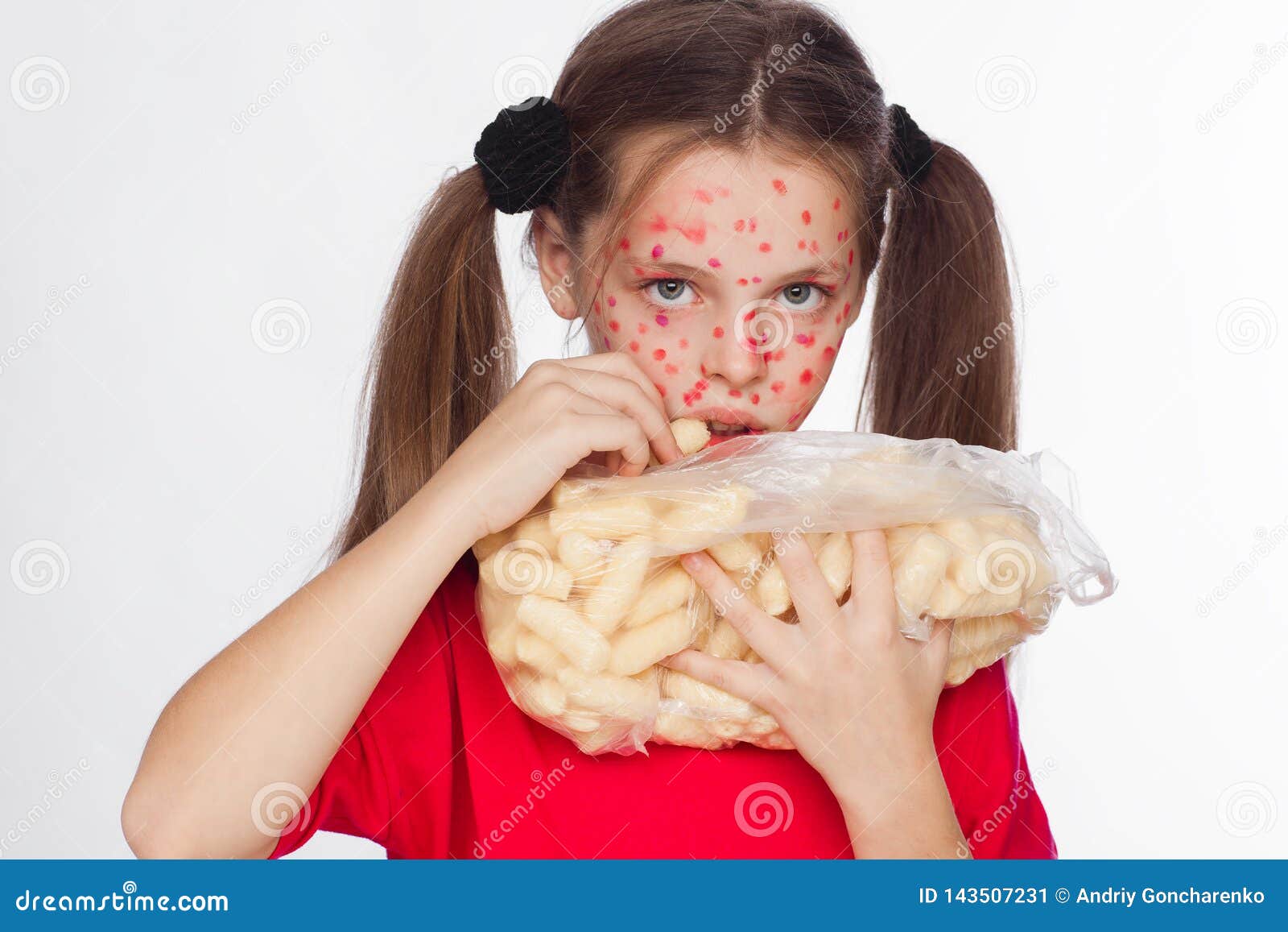 Front View of a Girl with a Problem Skin Rash Who Eats Corn Sticks