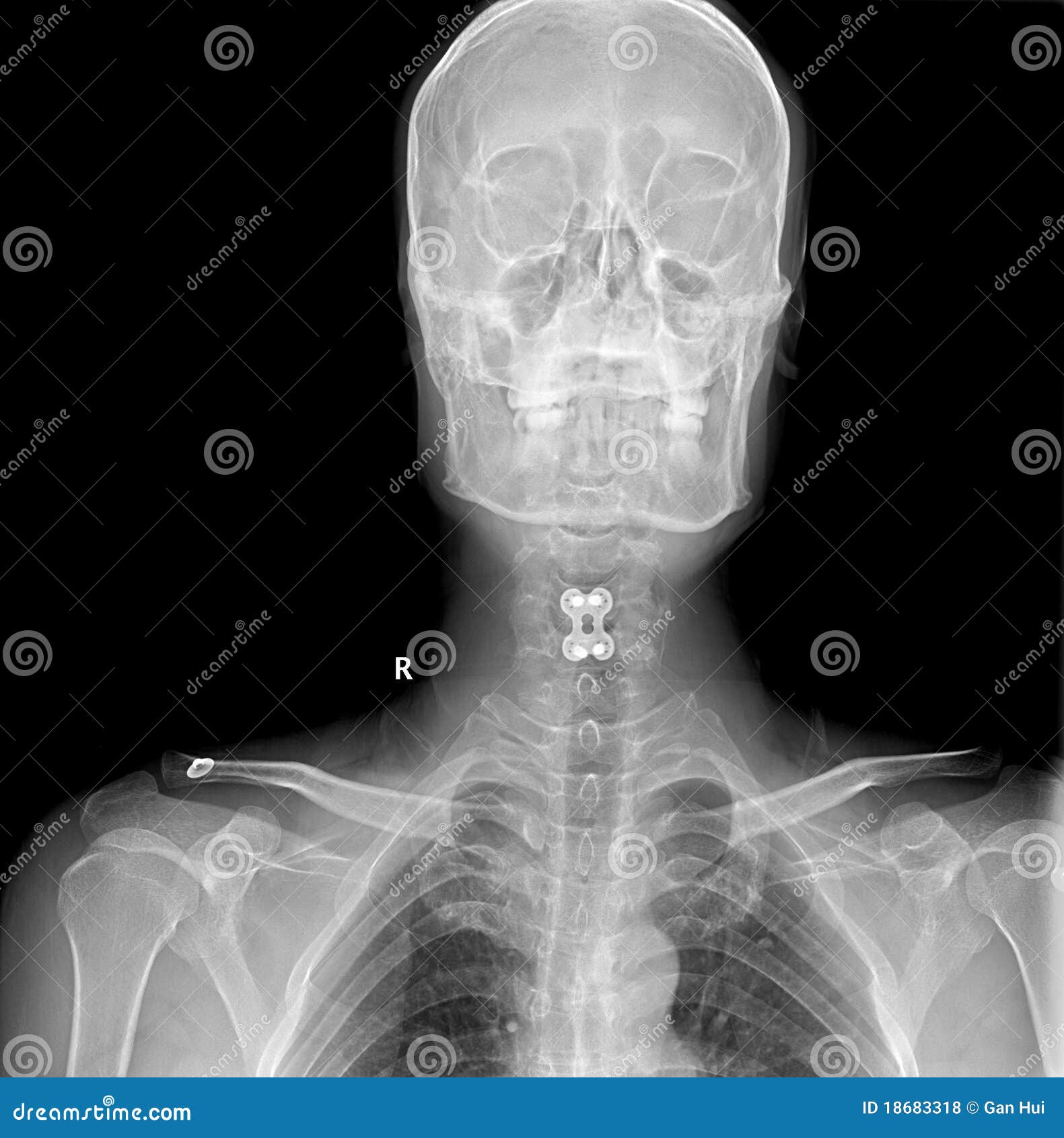 Front X-RAY IMAGE Of Cervical Spondylosis Royalty Free Stock Photos